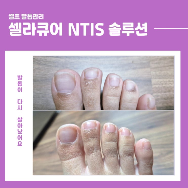 셀라큐어 NTIS 솔루션, 발톱 틈새까지 신경 써본 솔직 후기