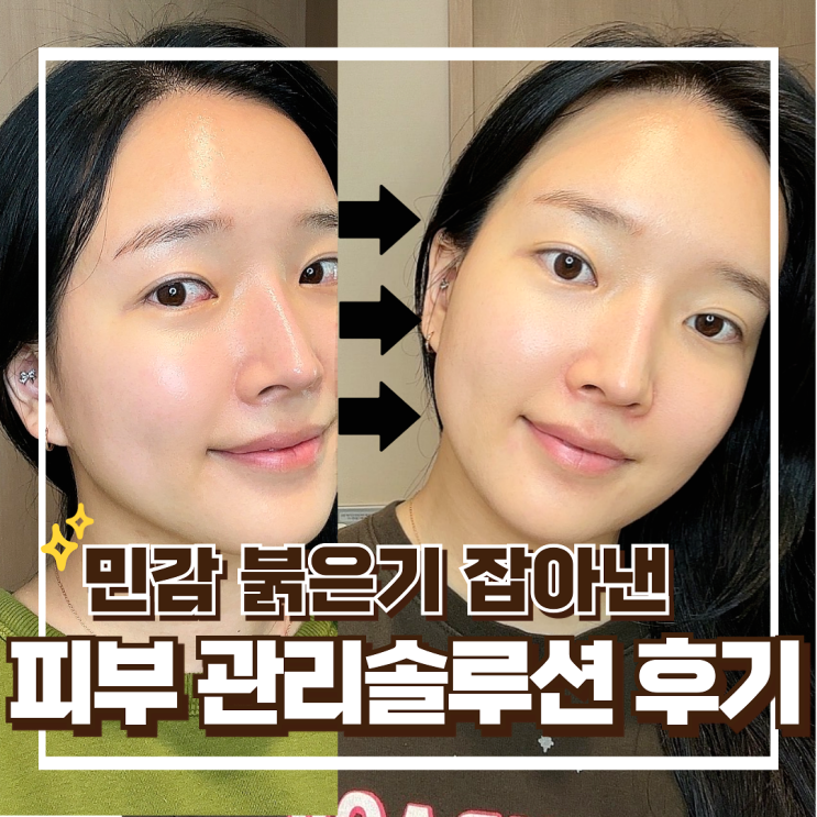 맞춤형 피부 관리 플랫폼으로 얼굴 붉은기 진정된 해듭풀패키지 찐후기