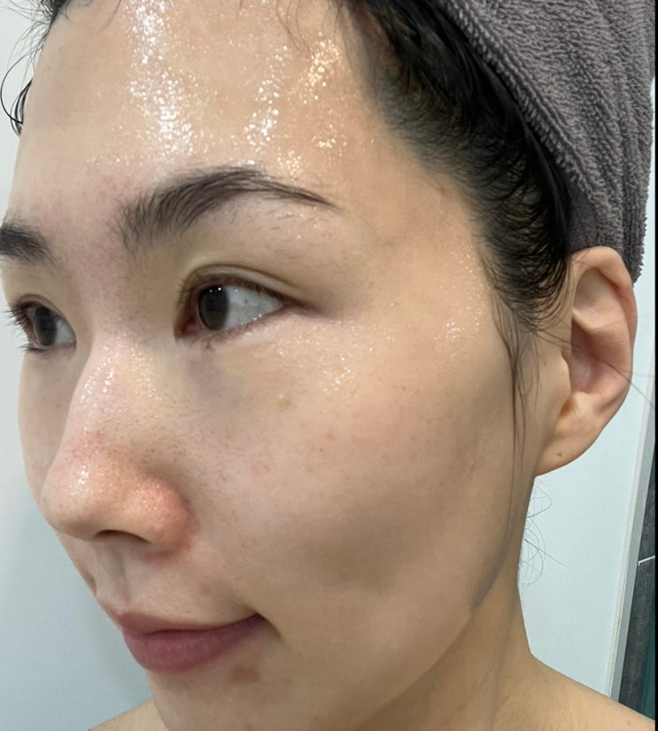 피부과재생크림 EGF재생크림으로 레이저 시술 후 관리해요