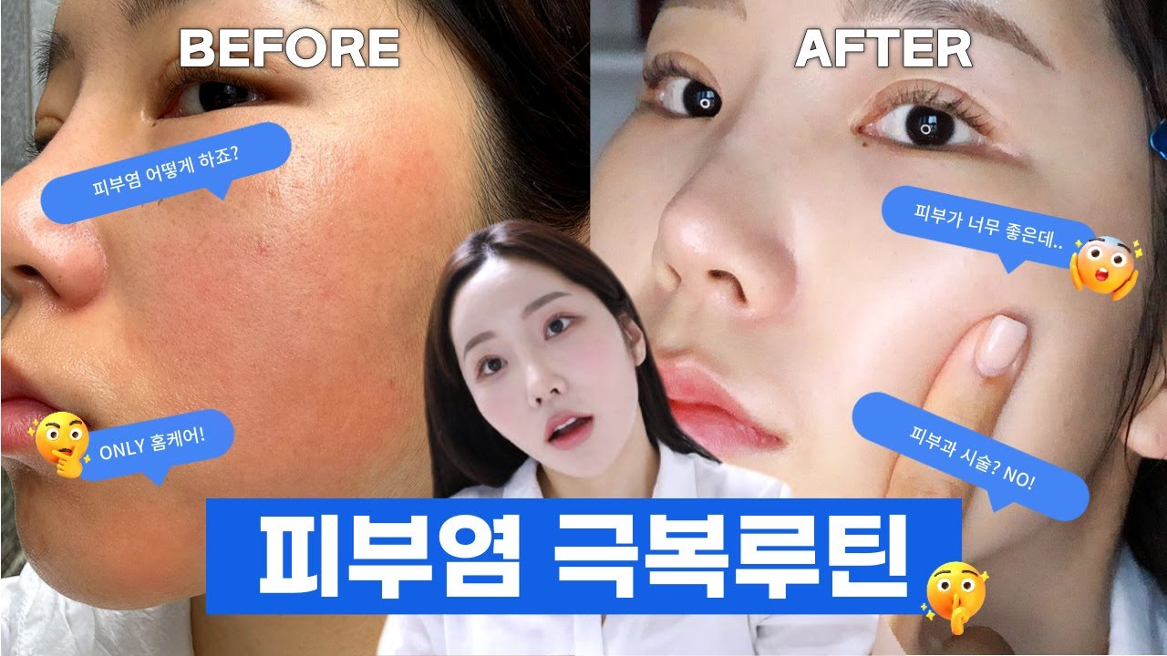 광고❌ only 홈케어로  피부염 극복 스킨케어 루틴ㅣ하루 20분 피부염증 없애는법