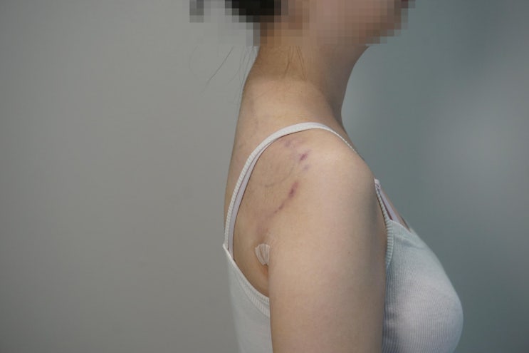 내돈내산 버팔로증후군 버팔로험프 지방흡입 수술받고왔어여
