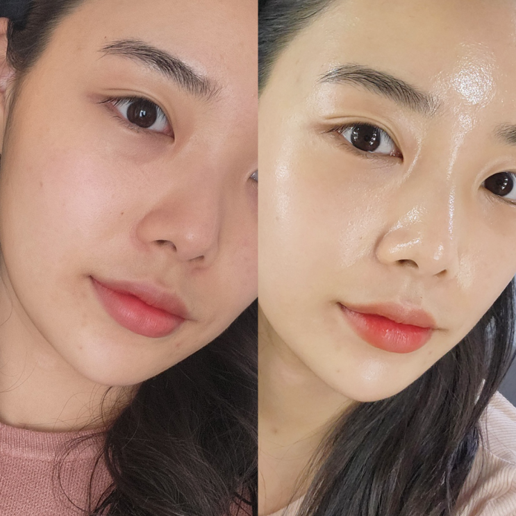 엑소좀 효과 닥토필 가격, 전후 사진有 / 소요시간 강남 에스테틱 [리무드]