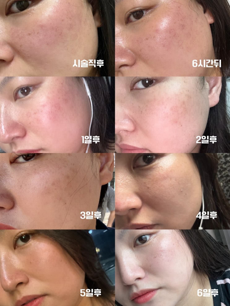 [신논현] 강남피부과에서 수분가득 넣고 피부재생이 효과있는 세렉소 엑소좀 스킨부스터