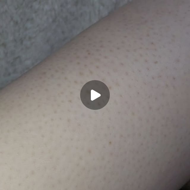 댜밍 | 경기 인천 맛집ㆍ핫플 | 밀키트ㆍ디저트ㆍ집밥 | 코덕 on Instagram: "#광고 @denong_official

모공 각화증 완화 특허 성분이 함유되어
모공 각화증에 특화된 전용 바디로션
드농 실키 앤 소프트 바디로션 💚

기존에 있는 기능성 로션들은
끈적이고 답답한 느낌이 드는데
드농 바디로션은 사용 후
바로 옷을 입어도 달라붙지 않으면서도
피부가 촉촉한 느낌이 들어요.

게다가 향료나 색소도 들어 있지 않고
천연 BHA 성분으로 모공을 막고 있는
단단한 각질을 연화시켜
자극 없이 각질 케어가 가능해요.

안 그래도 팔과 다리에 닭살 때문에
곧 다가올 여름이 두려웠는데
미리 관리해야겠어요 !!

100% 환불 제도가 있는 만큼
효과가 확실할 거라 믿어요 👀

.
.
.

#바디로션#모공각화증
#닭살피부#피부오돌토돌"