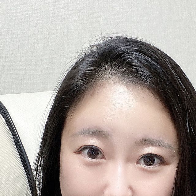 성해니 on Instagram: "#협찬 YDY뉴트리션 파이토알엑스 라이버맥주효모🎶

기온이 슬슬 떨어지면서 환절기라 모발이 점점 푸석해지는 느낌이 들었어요🤔

샴푸 할 때 평소보다 머리카락도 더 많이 빠지는 거 같고 추워져서 그런지 두피도 건조해지는 것 같아서 사용하게 된 제품인데요❣️

맥주 효모와 비오틴이 같이 있는 제품이라 눈에 띄었고 한 포에 맥주효모가 3,000mg이나 함유되어 있더라구요🫢

1954년 설립된 맥주 효모 발효 전문 기업인 독일의 라이버사의 맥주 효모를 사용했는데요😊

라이버 맥주 효모는 한 포에 맥주효모 3,000mg과 비오틴 1,120mcg, 판토텐산 400mcg이 함유되어 있다고 해요⭐️

보통 맥주 효모와 비오틴이 고함량이면 피부 트러블 발생할 수 있다고 부작용 걱정을 많이 하기도 하는데요💝

피부 상태 개선에 도움을 주는 판토텐산이 같이 함유되어 있어 걱정 없이 사용할 수 있었어요👍

먹는 시간이 따로 정해져 있진 않아서 하루 중 가장 먹기 편한 시간대에 챙겨먹으면 끝‼️

다이어트로 영양결핍 증상이 나타나는 분
나이가 들수록 빠지는 영양을 채우고 싶은 분
불규칙한 식습관을 가지신 분들께 추천드려요🎁

☀️구매처 링크 : https://bit.ly/48a2TWw

#광고 #맥주효모비오틴 #맥주효모먹는법 #맥주효모영양제 #맥주효모단백질 #맥주효모효능
@pharmabros_official"