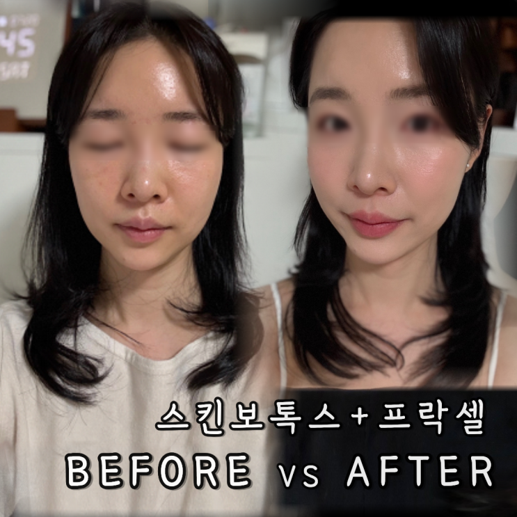 신사성형외과 프락셀 스킨부스터&도로시물광주사 효과 가격 통증