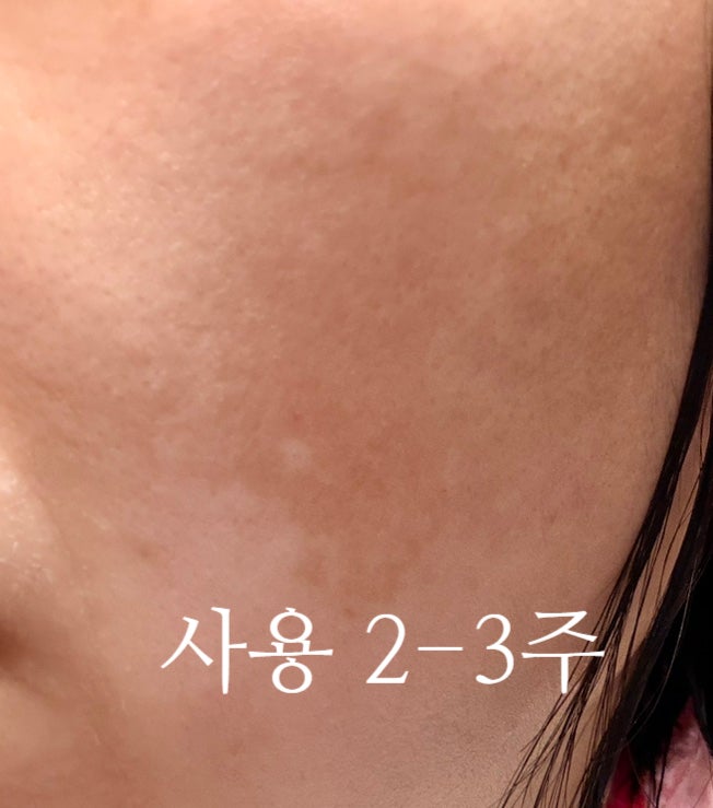 민감성 피부를 위한 화이트 단델리온 에센스 수 한달 사용후기 탈리다쿰 에센스 수