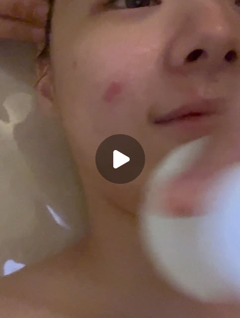 woni on Instagram: "#협찬 
📌파주 운정 연에스테틱피부관리샵에서
ARDIV EXOCULE 엑소좀 스피큘 관리 중 
‘Pure Skin Booster’ 시술 후기입니다!

여드름이 많던 피부였는데, 
단 1회 만에 피지 밸런스 잡히고 
붉은기가 정말 많이 옅어졌어요. 

원장님께서 3-4일 뒤에 정말 신기하게 
피부가 좋아질거다 하셔서 그런지
시술 당일과 다음날엔 스피큘 특유의 따끔함이 있었지만, 
놀랍게도 붉은기 하나 없이 진정됐고 
3-4일 뒤 피부가 한결 부드럽고 맑아졌어요. 

피부 열감이나 민감성 피부 때문에 
고민하신다면 정말 추천해요!

#야당피부관리 #야당피부샵 #파주피부관리 #파주피부샵 #운정피부관리 #운정피부샵"