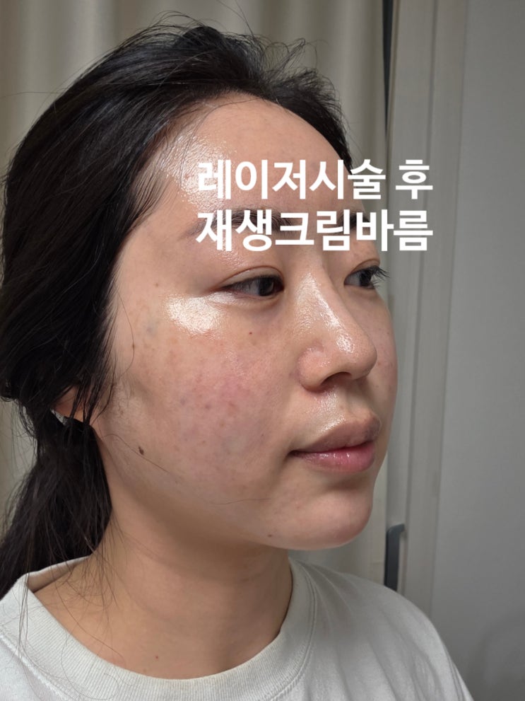 레이저시술 후 예민한 피부를 위해 피부과 EGF재생크림 사용