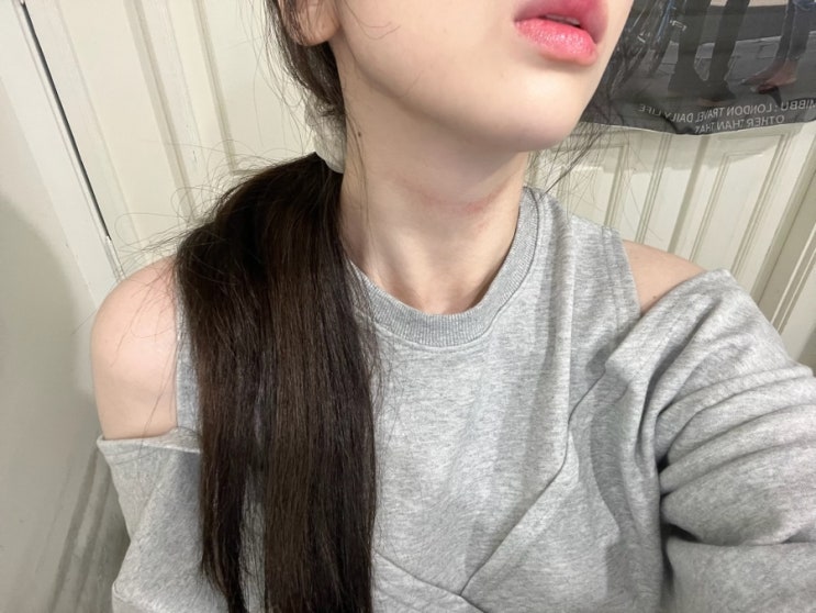대구플라즈마 “뷰티메이커” 목주름 시술 후기