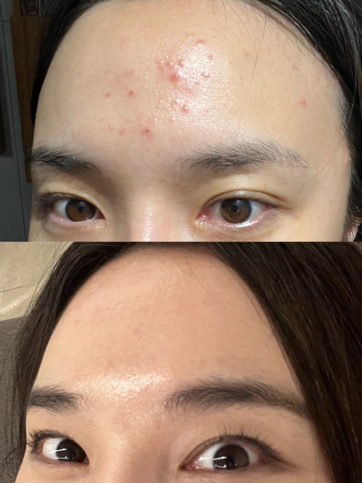[ 인워드 ] 아가스 아크네 #여드름폼클렌징 찐후기 ✨ 폼클추천