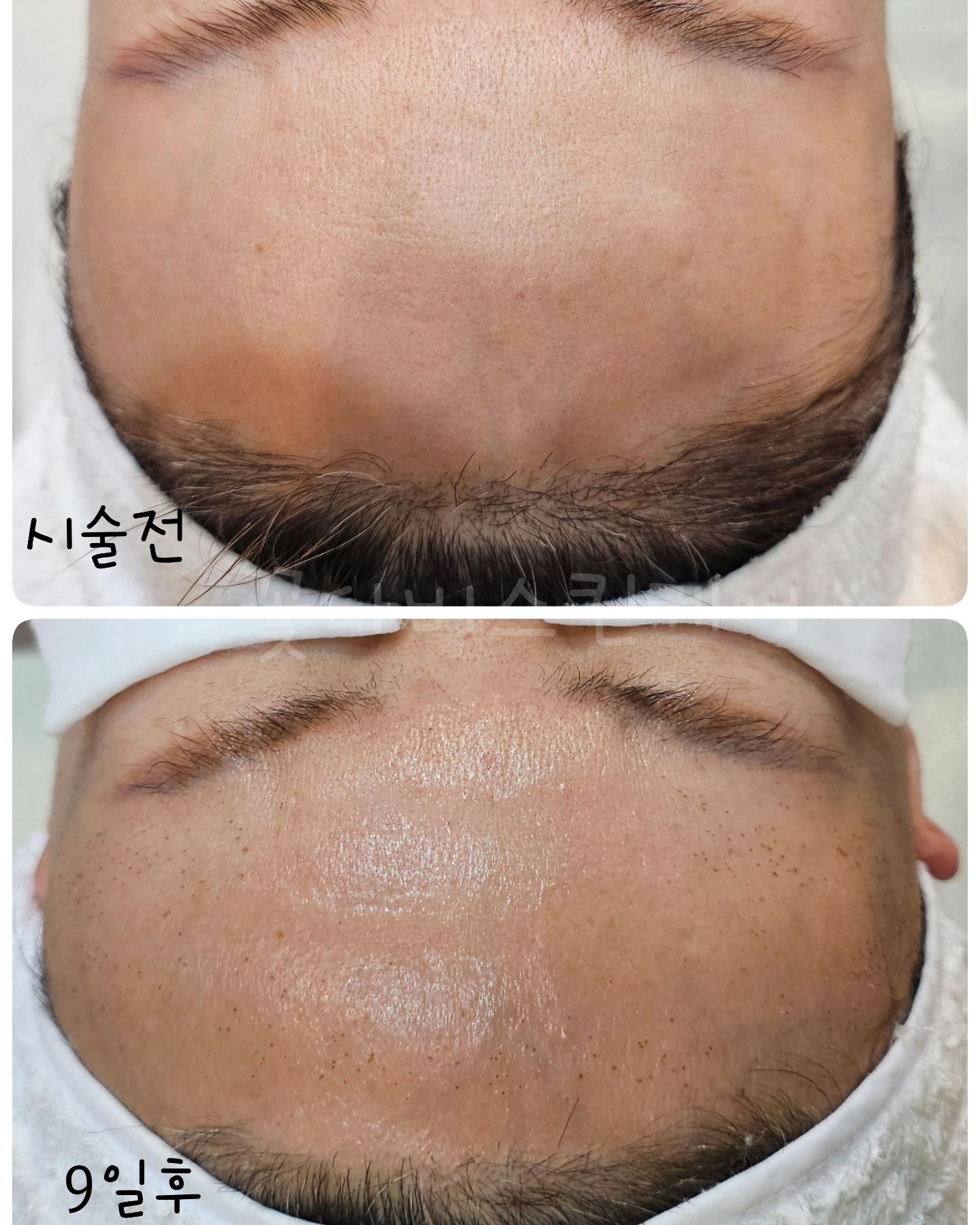 플라즈마×스킨타이트닝 
이마 눈가 관리하신 고객님 주말에 연락와서 설연휴전에 
하고 싶다고 하셔서 급하게 관리해 드렸는데 
엄훠 안했으면 큰일날뻔 🫢

효과가 너무 좋잖아 👍
이마 볼륨이 완전 빵빵하게 살아나서 깜놀 
매번 내 이마보고 볼륨 .광이 장난아니라고 하셨는데 
이제 고객님 이마도 한몫하네요!

잔주름이 볼륨 때문에 탱탱해지고 이마 라인이 탱탱하게 
정리 되니까 전체적으로 어려보이고 
눈썹이 높아져 눈도 더 시원해 보이고 톤은 당연리 맑아지고 

플라즈마 부작용 없고 피부재생으로만 좋아진거기 때문에 
안전하고 오래갑니다 

피부관리만 잘해주시면 완전 👍 

이제 광대 한번 가시죠🫢

#송탄 #플라즈마 #피부관리 #스킨타이트닝