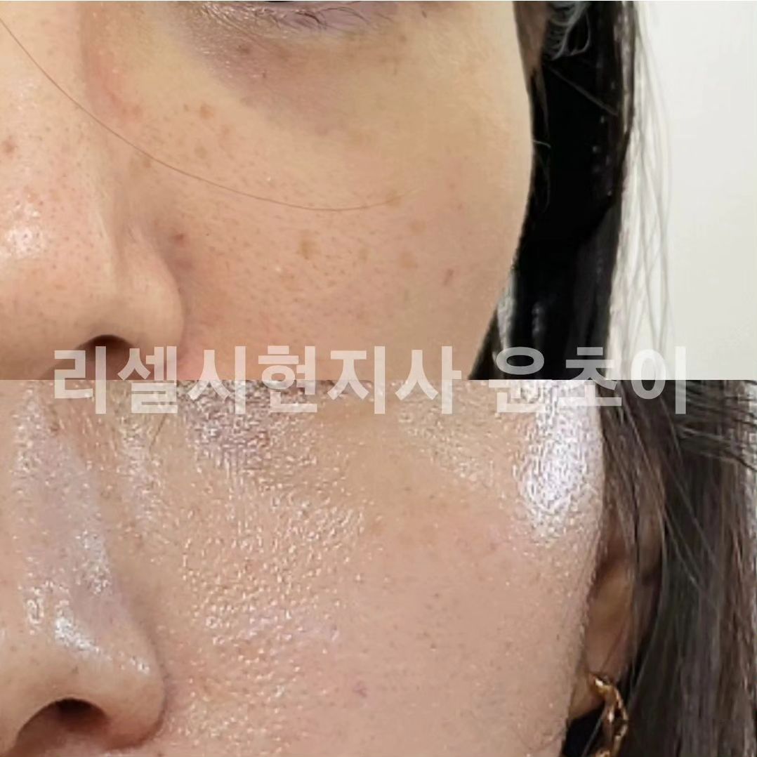 ⠀
⠀
트러블도 잘 나고 예민한 내 피부
기초 하나 바뀌면 귀신같이 알고
트러블 올라오는 내 얼굴
⠀
그 트러블 가만히 못 냅둬서
흉터 가득한 내얼굴
⠀
애를 낳고 나니 생긴 기미들
피부과를 가도.... 별효과를 못봣는데
⠀
리셀 쓰고 저 진짜 피부 인생 2회차입니다
⠀
하....제 피부지만 너무 놀랍네요
⠀
피부과에 이젠... 돈몇백 안써두되서
너무 행복한 요즘❤️
⠀
#리셀화장품 #리셀시현지사 #리셀초이스대리점 #기미잡티 #트러블피부
#파란병