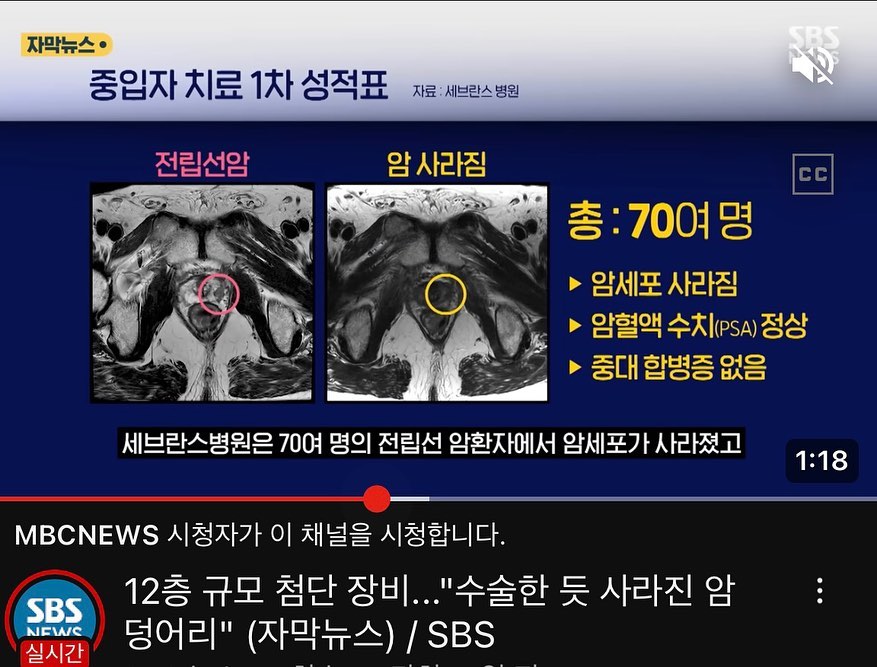 https://youtu.be/DqlEP8zf2cE?si=Hma_apeY1A7avVsu

중입자 성공후 뉴스 보도중

암은 이제 치료못하는 병이 아닙니다.
하지만 치료는 가능하지만 치료비가 비싸서 돈이없어서 치료를 못할뿐이죠..

암의 종류와 환자의 상태에 따라 다르지만
적게는 몇천 많게는 억대까지의 치료비(전립선암 4-5천만원 중입자 치료비만)

무엇으로 치료비를 감당할수있을까요~?
표적항암,세기조절등등 7천에서 1억 보험 담보넣는데 커피값에서 치킨값 정도라면요~?

선택은 본인 몫.. 

궁금한점이나 문의주세요
