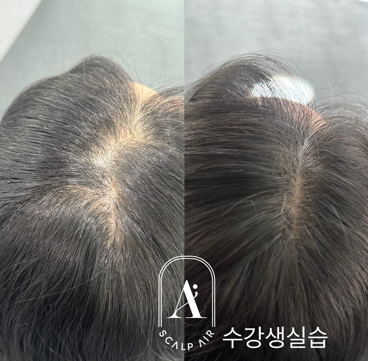 울산 WOOAH BEAUTY 우아뷰티⠀
스칼프에어 공식 울산북구지사 🇰🇷⠀
⠀
ヽ미용인이라면 다 아는 두피컬러링 ❝스칼프에어❞⠀
ヽ기존 문신기법 (X) 신개념 두피컬러링 두피염색⠀
ヽ미세도트 고운입자 표현 ⠀
ヽ데미지없는 스피드한 시술시간⠀
ヽ부작용 뭉침 번짐 푸른잔흔 X⠀
⠀
⠀
⠀
남성 여성 탈모⠀
탈모커버⠀
구렛나루커버⠀
헤어라인⠀
M자탈모⠀
가르마탈모⠀
정수리탈모⠀
⠀
⠀
⠀
예민,꼼꼼한 WOOAH BEAUTY가 스칼프에어를 선택한 이유!⠀
쾌적한 환경에서 완벽한 수업으로 직접 느껴보시고 배워갈 수 있습니다. 미용인이라면 필수로 알아야하는 ❝신개념 두피컬러링❞⠀
⠀
⠀
시술/수강 문의가능⠀
⠀
⠀
#울산두피문신 #울산두피컬러링 #울산두피컬러링교육 #울산두피문신교육 #울산두피컬러링수강 #울산두피컬러링수강_우아뷰티 #울산두피컬러링교육_우아뷰티 #스칼프에어 #스칼프에어_나나 #울산두피 #울산탈모 #울산탈모커버 #울산탈모커버전문 #울산탈모_우아뷰티 #울산반영구수강 #울산스칼프에어_나나 #울산스칼프에어수강 #울산스칼프에어세미나 #울산눈썹문신 #경주스칼프에어 #경주두피문신수강