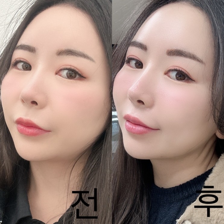 홍대입구역 피부과 추천 받아 텐써마 300샷 피부 탄력 전 후 사진