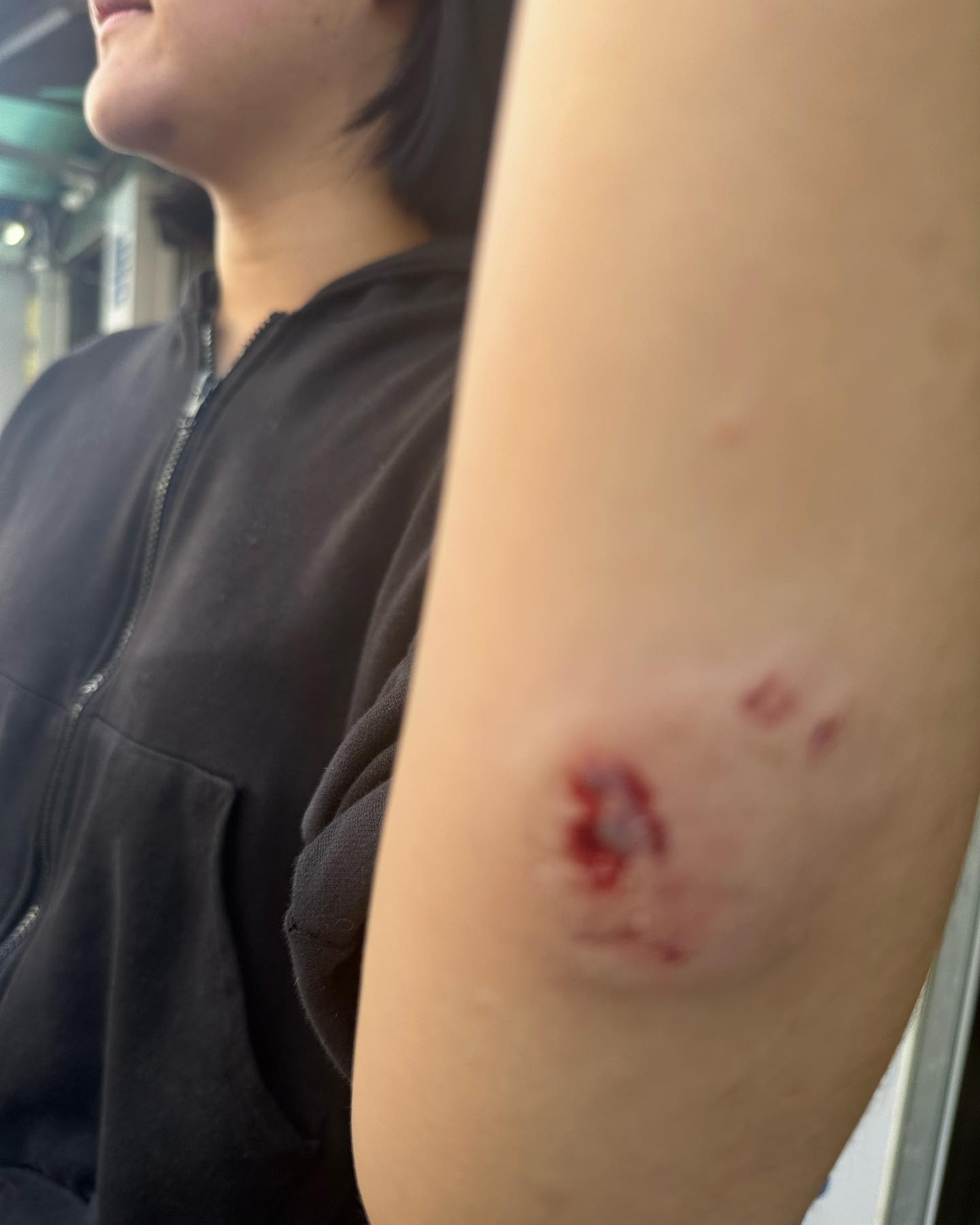 오늘 오전자 맞짱 까다 광견병 걸려서 물어 재낀 썰 푼다