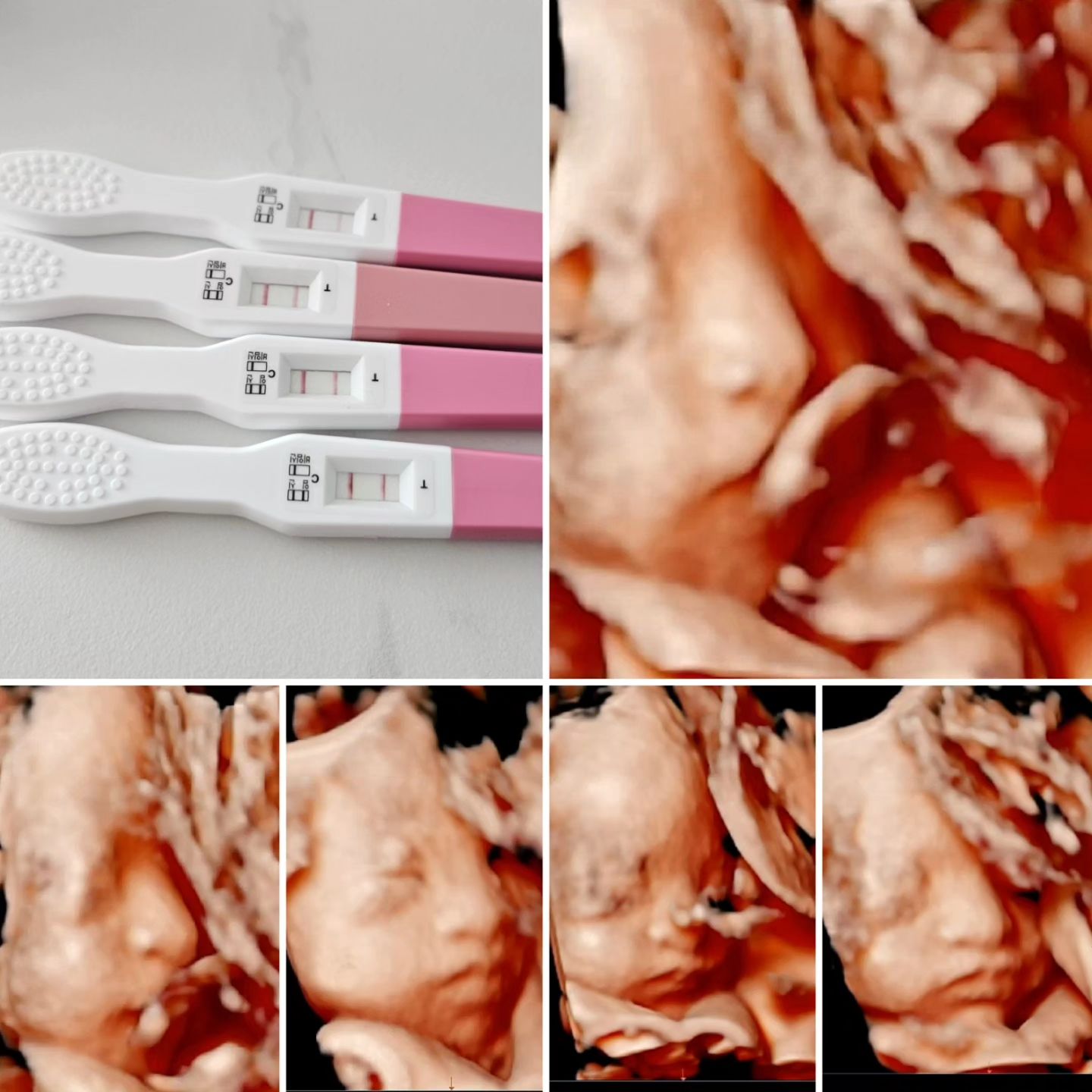 #첫줄👋 
오늘 얼굴 처음 본 기념으로 꿀벌이👶 임밍아웃🤰🏻

예식 앞두고 갑자기 찾아와서 너무 놀랐었고
(믿을 수 없어서 테스트기 한번에 4개 썼던..)

결혼식이랑 신행 앞두고 있어서 걱정도 많았는데
내 몸이 별로 안좋았는데도 다행히 잘 크고 있는 👶
난 임신체질 절대아님🤢☠️ #입덧지옥 🤮

오늘 협조를 안해서 정면 얼굴은 못봤지만
입체초음파로 얼굴이 나오니 신기하네..ㅋㅋ

눈뜬거 찍혔는데 눈뜬 사진은 아빠 닮은듯..?🫨

남은기간 별 문제없이 있다가 잘 나오길.. 🐝
목요일에 갈땐 얼굴 잘 나오게 협조 좀 해라

#임밍아웃 #입체초음파 #얼굴 #신기하네
#👶 #딸 #누구닮았니 #얼굴좀보자 #협조좀 
#아기 #태아 #초음파 #임신 #임신스타그램