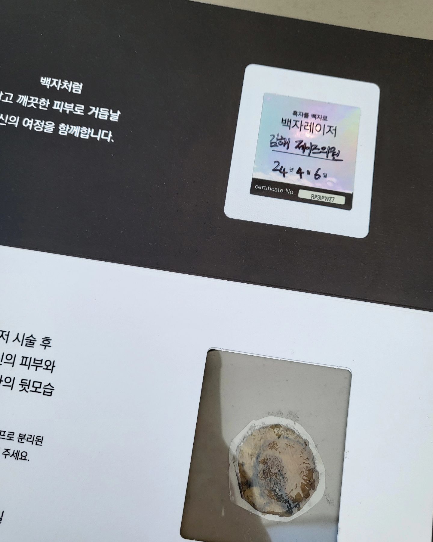 다들 잘지내셨나용😊🫶

제 얼굴에 흑자가 있는지도 그동안 모르고 살았는데요
그냥 잡티인가보다 했었거든요🥲🥲
점점 여름에 자외선 받으면 더 찐해지면서 커지는 느낌을 받아서 병원에 갔더니 흑자라고 하더라구요😭

요거는 레이저로 떼면 된다 하시더라구용!

이게 멜라닌 생성이 과하게 일어나면서 생긴 
갈색 병변같은 흑자라고 하더라고요 

커피반점처럼 점점 진해졌고요..😱😱

유튜브 찾아보니깐 리팟레이저 받으면 된다고 해서 
아침부터 근처 피부과 엄청 서치해보고, 
리팟레이저 기기 있는 곳으로 가서 시술 받았어요 

시술받고 2주 뒤에 듀오덤 떼면서 흑자까지 자연히 떨어져나갔네요 !! 

인친님들도 그냥 잡티라고 넘어가지말고 꼭 한번은 피부과가서 진료 한번 받아보세요❤️🩷

#김해피부과 #백자레이저 #리팟레이저 #리팟 #reepot #백자레이저캠페인 #백자캠페인 #흑자 #흑자제거 #색소치료 #잡티 #잡티제거 #피부관리 #이벤트참여완료 #커피반점 #카페오레반점