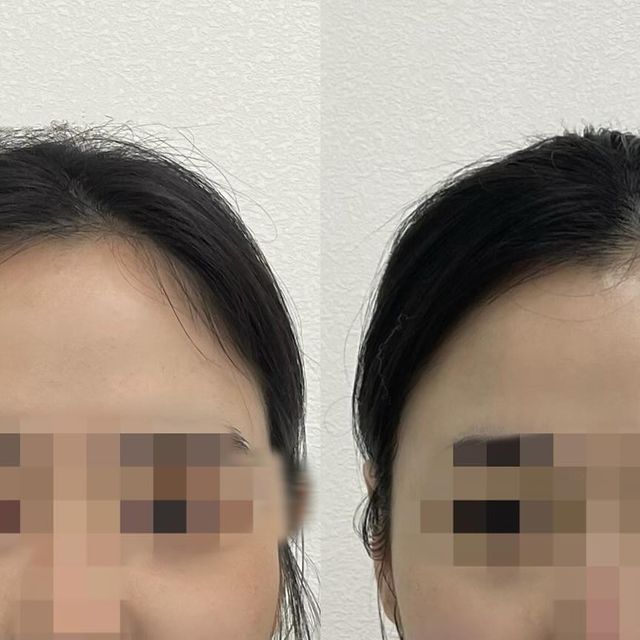 +(82) 소윤님이 회원님을 좋아합니다. on Instagram: "#광고 안면비대칭교정 하고왔습니다😆 . 얼굴 분석 후 침치료 진행되었구요! 총 20회중에 6회차 받은 사진인데 침 치료 후 하루하루가 눈에