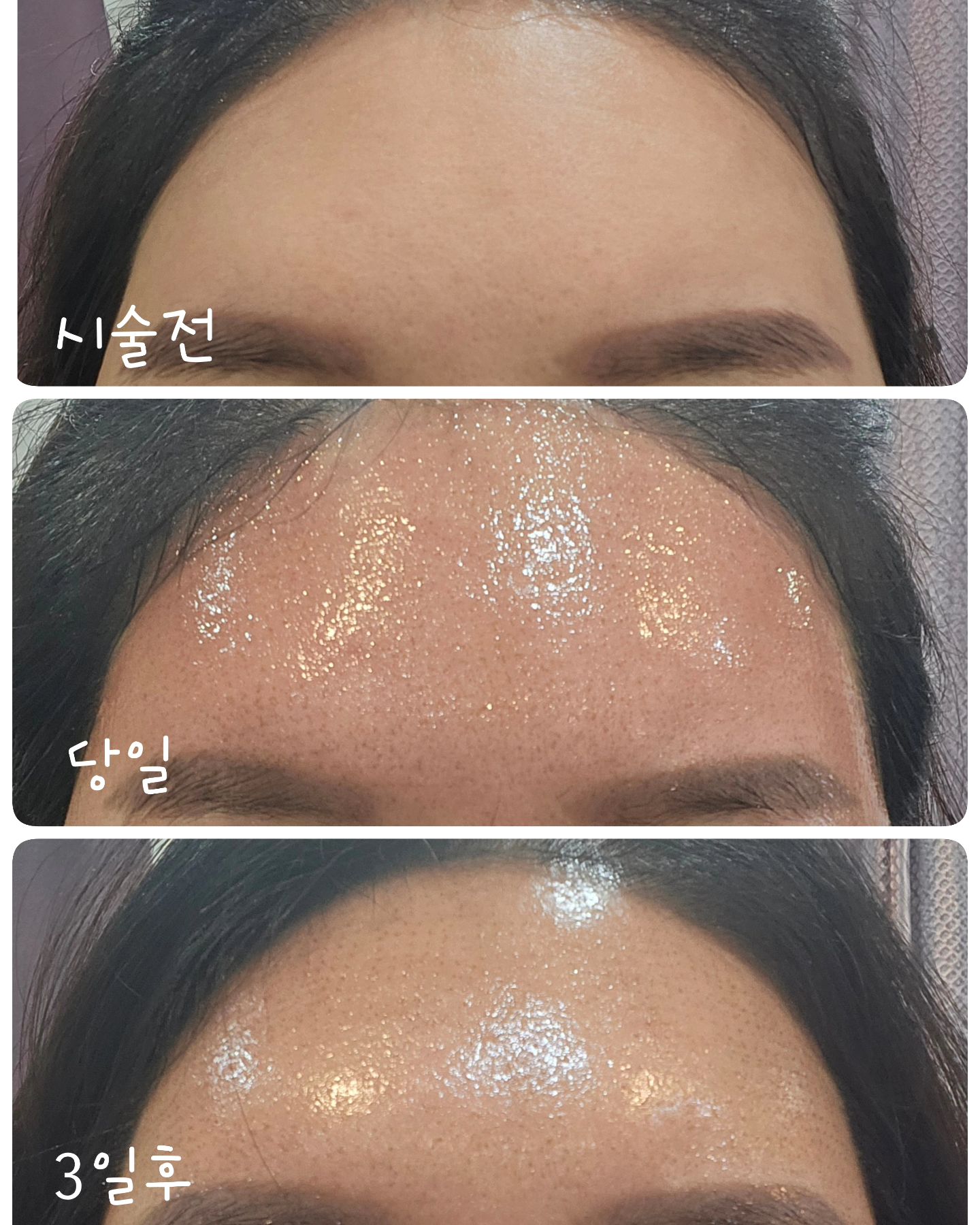 플라즈마×스킨타이트닝 
필러×보톡스를 맞으면 딱 이느낌이예요 !

일주일의.기적이랄까 
딱지는 재생에 따라 떨어지는 주기가 다 달라요 
빠르면 5일터 15일까지 서서히 떨어집니다 

딱지를 억지로 떼어내시면 안되요 
딱지가 있을때 피부속에서 재생이 일어난다구요

오래있을수록 좋아요 
재생이 오래 될수록 더 탄탄해 진답니다👍

지금#풀페이스 인기가 많아요 
저는 이마 먼저 하고 팔자주름 따로 따로 했었는데 
어차피 관리 해야하고 딱지붙은 얼굴로 어디 못나가니 
한번에 하겠다고들 하시네요 

근데 이마ㅡ했을때 딱지 생긴거 거의 몰르세요
사람들은 생각보다 남에게 관심이 없어요 
진짜네요 정말 관심있는 신랑만 알아봤다는 🫢

꼭 한번 해보세여 
이뻐집니다!

#송탄 #플라즈마 #이마거상 #보톡스 #필러