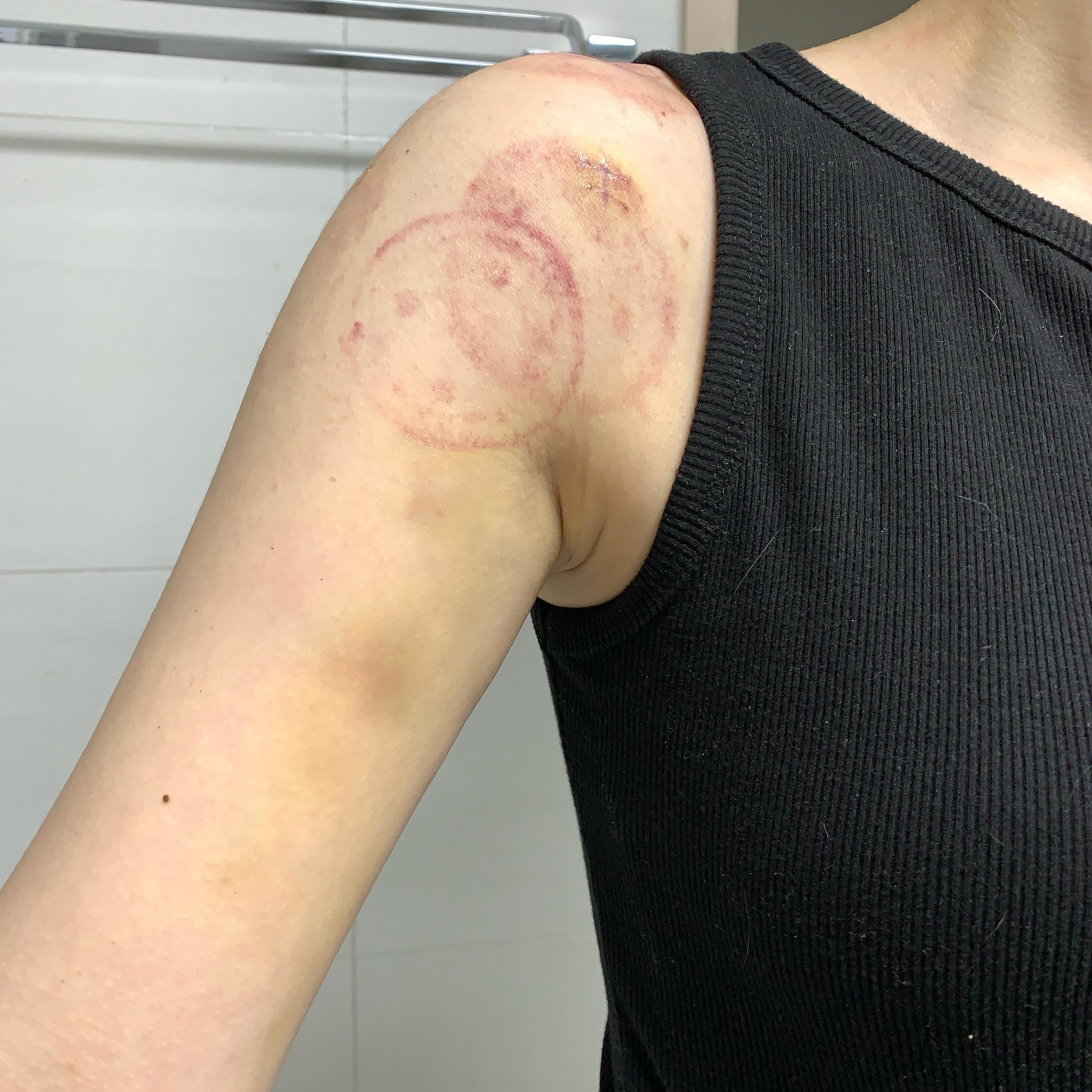 ⠀⠀⠀⠀⠀⠀⠀⠀⠀⠀⠀⠀ ⠀⠀⠀⠀⠀⠀⠀⠀⠀⠀⠀⠀ ⠀⠀⠀⠀⠀⠀⠀
이렇게보면 들지도 못할것 같은 나의 팔💪
열중셧~ 자세가 안되서 도수치료 받았는데
피부가 약해서 그런지 아주 멍이 멍이😱
스쳐도 아픈 상태.
-
-
-
-
#견봉성형술 #도수치료 #피멍 #일상 #소통 #환자스타그램 #아프다그램