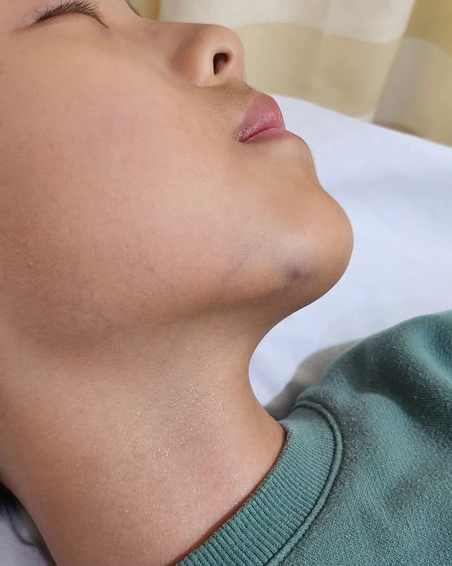 나의 후느..
올해만 벌써 네번을 쓰러졌다.
내 눈앞에서 걸어나오다 
앞으로 꼬꾸라지는 모습은..
잊을 수가 없는 충격이다.
가뜩이나 마르고 작아 걱정인데
두통에 복통에 어지러움증에....
이렇게 쓰러져버리면....
마음이 진짜 힘들다..
동네 소아과에서 다리 근육 경직에
속 울렁이고 어지럽고 두통이 지속되어
소견서 써줘서 큰병원 가서 검사 받았는데..
결과 나오기까지 얼마나 무섭던지.
다행이 걱정했던 큰 일은 아니었지만
이래저래 마음은 힘들었다.
두가지 의심으로 대학병원 가라고
소견서를 받았지만...
그래도 혹시나 치료하면...
우리 후느도...
살이 좀 찌려나? 하는 희망도 생겼고..
건강하면 좋겠어 아가...ㅠㅠ
얼굴로 넘어져서 턱에 멍이 들었지만
안경으로 안넘어져서 다행이다.
엄마 아들 화이팅!