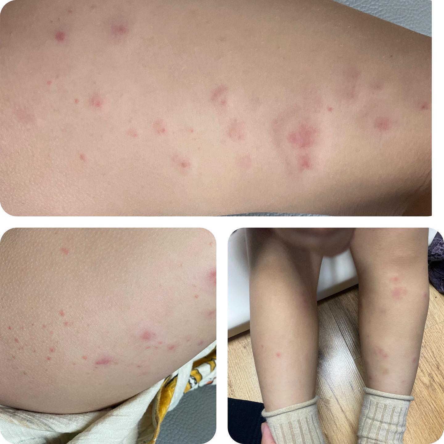 #뭘까? #아동학대아님 #벌레물림

어린이집 하원 후 발견…
단지 숲놀이 하고 하원했는데
“다리가아파”
마사지해주겠다고 만졌더니 다리가 부음😵‍💫
바로 바지벗겨서 확인….😱
무슨일이야 다리가 난리네….?
바로 삼촌에게 사진을 찍어보내고 확인전화🥹
급할때 삼촌께 SOS 👍

항히스타민제먹이고 시원하게 해주라고
바로 씻기고 항히스타민제 먹이고 한시간 후 사그라들었다…
통증이 있는지 제대로 걷지도 못하고 비상비상
몸부림 치는 아이인데 아파서 몸부림도 안치고 결국 진통제 먹이고 꿀잠 !!
아침에는 멍든곳 없이 가라앉았는데…
하원하고 집에 온 아이 다리를 살펴보니🙀

다리가 이게뭐냐….어제는 울긋불긋 부어서 난리
오늘은 온 다리에 멍들어서 난리

이게 무슨일….이런경우 있으신가요???

벌레에 물리면 이런경우도 있다는 삼촌말씀에 안심
삼촌은 직업은 소아과👨🏻‍⚕️ 
우리아이들 성장하는 동안 정말 많은 도움을 받고 있지요~

면역력이 떨어져서인지 ㅠㅠ 벌레에 물린건지….
애 셋우면서 이런일이 벌어진건 처음.
처음 아이를 발견하고…늦게발견해서 미안할 따름…ㅠㅠ

#육아일상 #육아일기 #벌레 #동래구맘 #부산맘 #어린이집일상 #알레르기 #숲체험