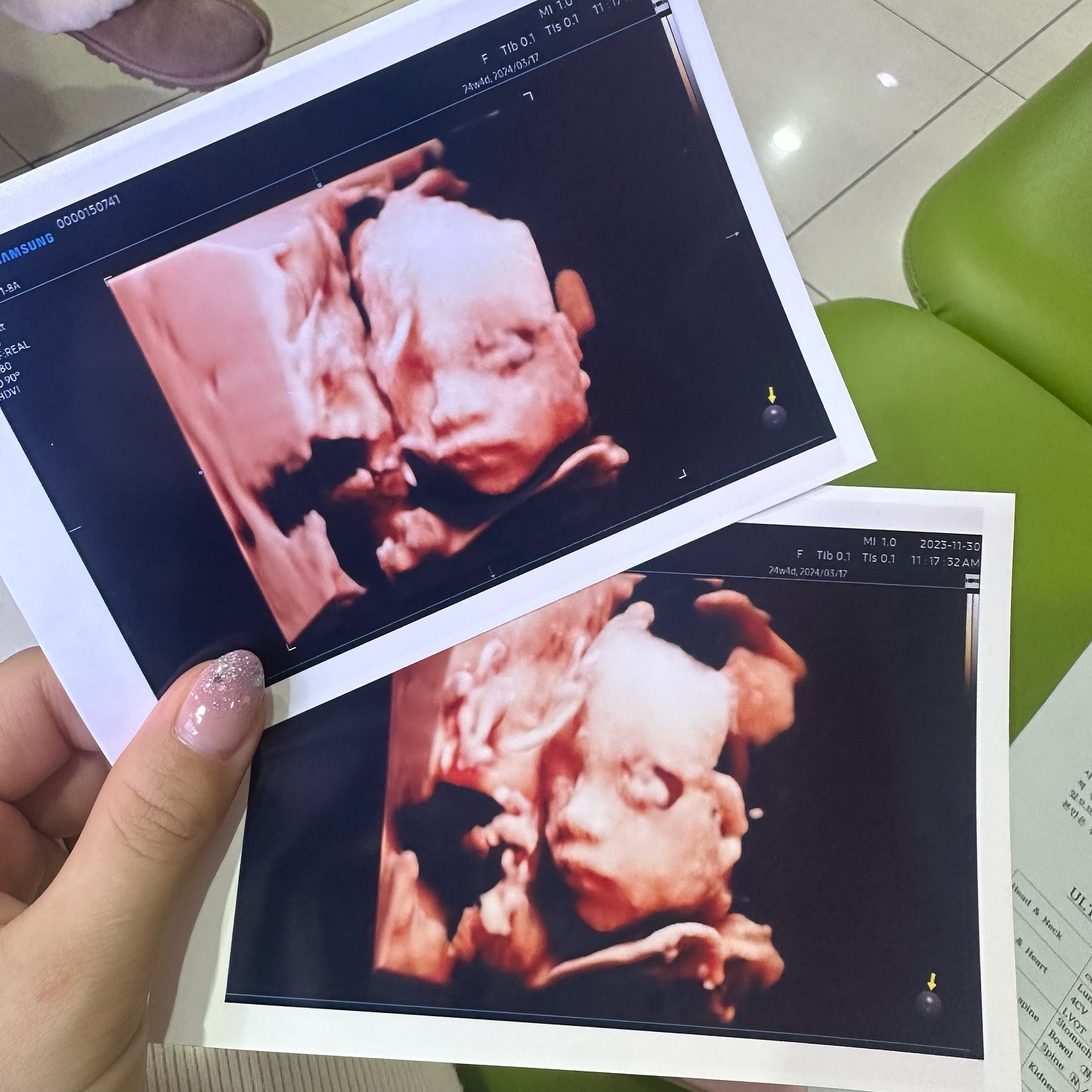 24w5d 
그새 또 많이 큰 울애기🍼
다음번엔 통통하게 살쪄서 더 예쁘게 만나🥹🤍

#청용띠아기 #청룡띠맘🐉 #딸맘