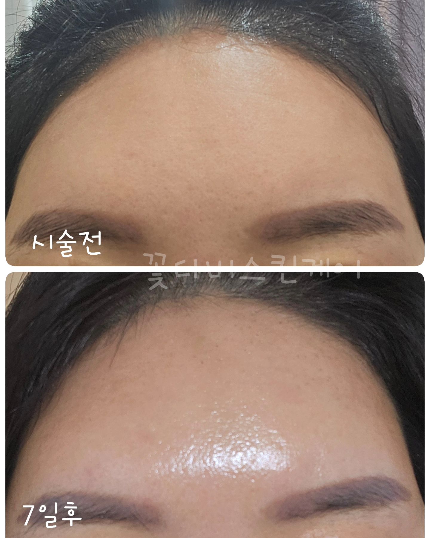 플라즈마×스킨타이트닝 시술전후 
눈커풀이 처져서 눈이 무거웠고 
나처럼 이마로 눈뜨는 사람들은 다 알거 같은데 
눈커풀 무거운느낌 ㅠ 

그래도 눈버쩍뜨면 되긴하지만 눈이 상당히 피로함 ..
그래서 눈매교정 근육땡기는거 했는데 
3년 안가는듯 .. 그래서 이제 포기 하려는데 

플라즈마 스킨타이트닝 효과가 너무 좋아서 깜놀😮
주기적으로 해줘야겠어 3개월후부터 효과 최상인데 
못참고 한달에 한번씩 하는중 ~

근데 이마 갑툭튀 
갑자기 볼륨이 살아나는 일석이조 👍
이마에 필러 보톡스 맞은것처럼 볼륨이 투욱 튀어나옴 

와 주름 없어지고 개이득 ㅋㅋㅋㅋ
담엔 헤어라인까지 해봐야겟다 ㅋㅋㅋ

#송탄 #플라즈마 #피부관리 #필톡스 #스킨타이트닝