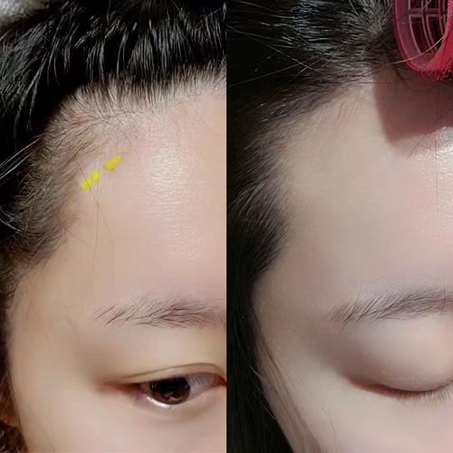 #협찬

피부 고민부위 케어는 
티 안나는 캐치미패치!

습윤패치에서 제가 가장 중요 시 여긴 것은 바로 [티가 안 나야 한다는 점]이에요.​
패치를 붙이고 있는 꼴이 좀 우습잖아요.
붙이더라도 좀 티가 안 나는 거여야 그나마 봐줄만하더라고요.
케어 중에도 티가 나지 않는 얇은 패치라 해서 선택했어요.

화장까지 마치면 진짜 감쪽같아요.
여기에 붙였구나하고 생각하고 보면 보이는데, 처음 본 사람들은 아무도 모를 껄요?

고민부위 압출 후에 붙여주면 되는데요.
평소 고민부위 관리할 때는 아래처럼 해보세요.
세안 후 알콜 스왑으로 고민부위를 닦은 후 붙여주세요. 피부진정에 더 도움이 될 수 있어요.

catchmepatch

#캐치미패치 #습윤패치 #트러블패치 #트러블케어 #피부진정 #스팟패치 #스팟케어 #트러블패치추천 #트러블관리 #패치추천