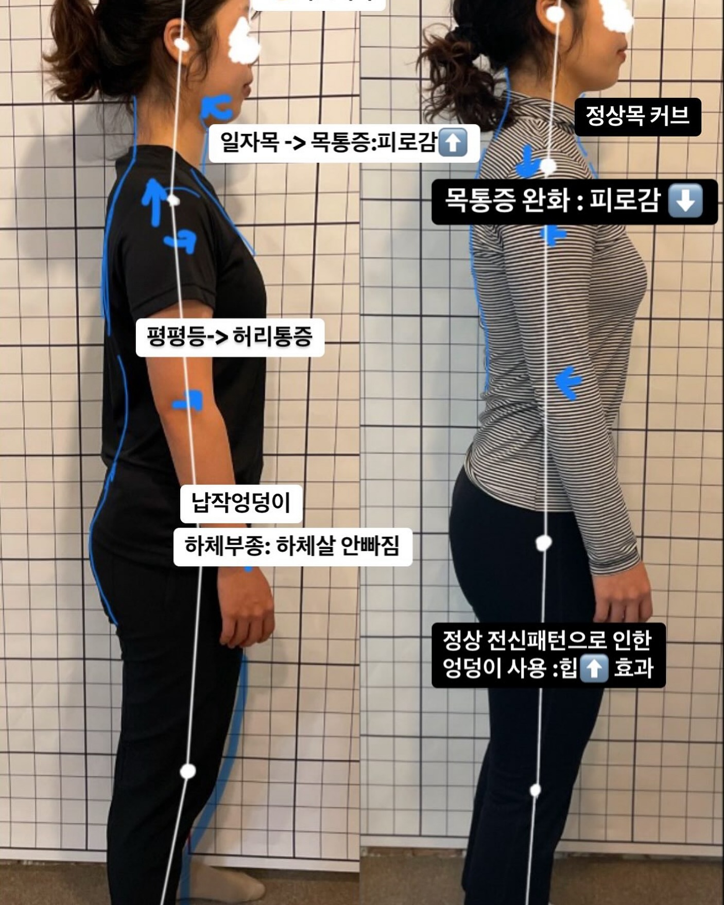필라테스 11회 전후 비교사진

첫날 평가
- 몸의 긴장도와 사고의 긴장도가 높으신분(업무강도가 높으신분)
- 평평한등으로 등을 사용하지 않고 일자목으로 상체를 세우는 패턴으로 인한 목통증(목으로 상체를 세우시는분)
- 무게중심이 앞으로 쏠려있어 엉덩이와 등을 사용하지 않는 패턴 습관적 자세패턴 -> 발아치 무너짐 -> 무릎통증
- 좌우 비대칭 한쪽으로 잠드는 습관으로 왼쪽측면 수축성 그것으로 인해 좌우 등 비대칭 발달 -> 골반의 비대칭
- 스쿼트 시 고관절 사용이못함. 발가락과 앞벅지로 사용함 이부분 개선 후 엉덩이로 활용해서 움직임
- 고관절의 사용을 안함으로 하체살 안빠짐 -> 종아리 두꺼움 : 고관절 합힘인식하는 프로그램 적용

11회 후 결과
- 자연스러운 목커브 -> 목통중 어깨통증 완화
- 등의 정상커부 먼듬 -> 승모근먼 사용하는 편향적 근긴장 완화힘: 전반적 근긴장 완화로 인한 깊은 수면을 하게 돼심
- 허리의 큰 커브를 등커브를 만듦으로써 허리커브 각도 줄임 : 허리통증 사라짐
- 엉덩이를 사용함으로 앞벅히두꺼움이 줄음 : 무게중심이 뒷쪽으로 이동됌

이후 계획 : 좌우 불균형 맞추기 포인트로 수업진행
#자세교정 #자세교정필라테스 #재활필라테스 #운동치료 #운동역학 #목통증 #허리통증 #무릎통증 #무릎재활 #움직임교정전문가 #운동심리 #심리운동 #심리운동수업#마포필라테스 #공덕필라테스 #공덕재활 #마포재활운동