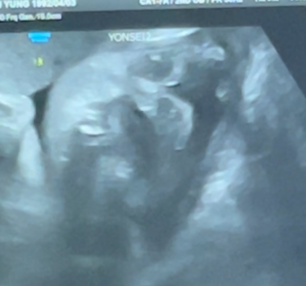 우리탄탄이는 #폭풍성장중👶
우~❤️ 귀여운 내입술 좀 보쎄요~ 
1.5kg가 되었다. 여전히 큼직큼직#👼 
이제 7kg이 쪘는데 다 탄탄이가 찐거지? 
엄마는 그렇게 생각해…#🤰
10월말에 무사히 나오자#🥰 #💕 
다음달 막달검사에서 만나#❤️ 
#청용띠맘#딸맘#우르르까꿍🙈