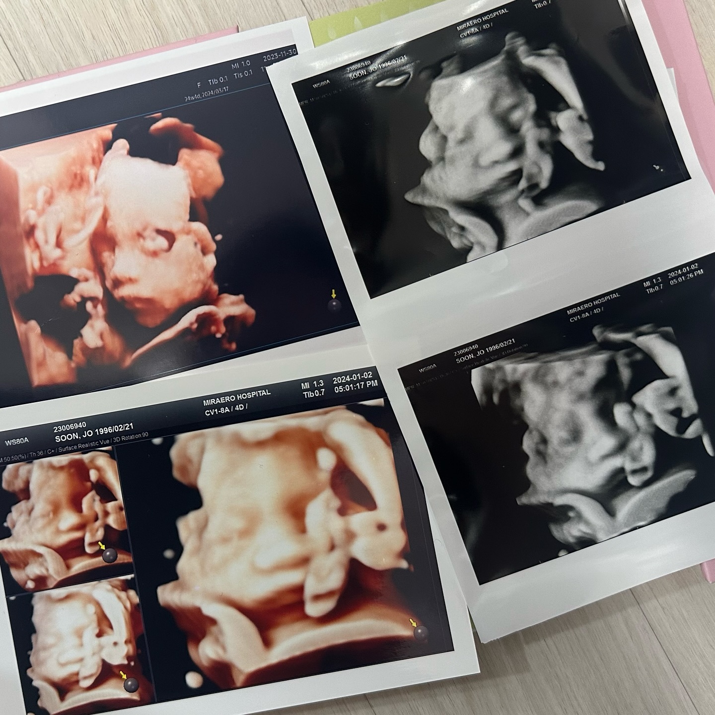 #29w2d
2차 정밀 초음파 땐 예쁘지만 너무 작아서 걱정했더니
3차 때는 통통하게 살이 올라 더 예뻐질 거라고
분명 선생님이 그랬는데
왜 만두가 되어버린거죠?👶🏻

#청룡띠아기 #아기만두 #예비엄빠