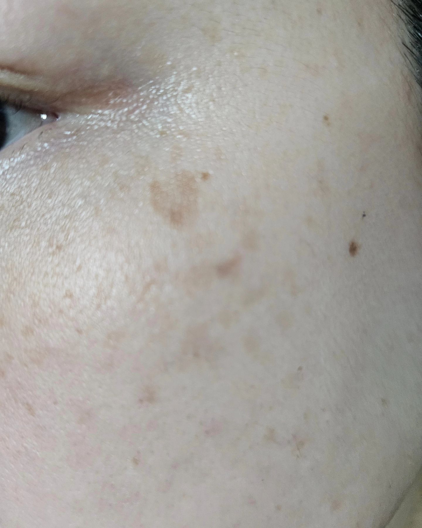나이드니
얼굴에 거뭇거뭇한 흑자들이 왜케 늘어나는지..

이런 흑자만 없어도 한층 더 깔끔해 보이겠네..라고
생각은 늘 했지만 흑자 한 번 없애려면 레이저만
10번을 넘게 받아야 된다고 해서 포기.. 그러던 중

리팟레이저를 알게 되었고
리팟레이저는 VSLS 기술로
흑자가 1회만에 제거되고 혈관 손상이나
색소침착.. 붉어지는 피부 홍반증 같은
부작용도 없다고 해서 바로 병원 방문

병원 방문하고 내 얼굴에 흑자가
정말 흑자가 맞는지.. 흑자인척 하는 
기미는 아닌지 상담 후에 리팟으로
제거 가능한 흑자인걸 확인!

마취크림 도포 후
레이져 지지직 후
주사 맞고
시술 끝 ㅎㅎ

정말 빠르게 끝나기도 했지만
쿨링 기술 땜시 하나도 안 아팠던.. 

2주 동안 습윤밴드 절대 떼지 말라는 것 외에
몇 가지 주의사항을 듣고 끝!!

2주후에 습윤 밴드를 떼어냈는데
대에에에에에박!!!!
언빌리버블...
없어졌다
있었는데...없어졌다....ㅎㅎ

습윤밴드 제거 후 2주동안
재생크림을 바르는 후관리가 있지만
내 피부가 깨끗해 진다는데
머가 대수랴...ㅎㅎㅎㅎ
내 눈으로 깔끔해진 피부를 보니
너무 기분 좋음..ㅎㅎ

1회로 끝낼 수 있다는 게 너무 좋은 것 같다 ㅎ

그리고 피부과 선생님들...너무 친절함...🤭
흑자 고민이라면 리팟 알아보시길… 🤭

#흑자 #얼굴흑자제거 #흑자관리 #백자피부
#흑자제거 #흑자레이저 #흑자제거비용 #흑자제거레이져
#백자리팟레이저 #리팟 #백자레이저 #검버섯없애는법
#검버섯레이저 #손등검버섯 #얼굴검버섯제거 #검버섯레이저비용
#검버섯제거비용 #피부관리 #잡티관리 #리팟레이저 #reepot #흑자 #검버섯