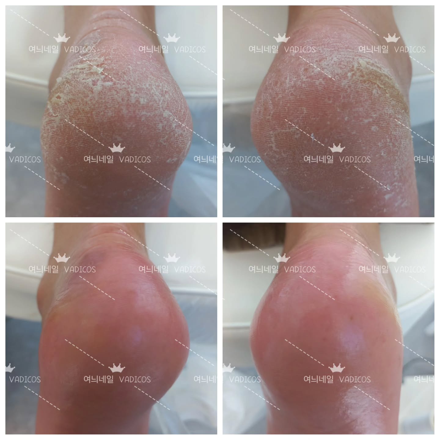 남자분들도 관리는 예외가 아니에요~~
방치하면 더 심해지는 발각질

양말속에 숨기지마시고 관리하세요^^♡

항상 노력하는 여늬네일이 되겠습니다^^♡

월-금 10시~9시
토요일 10시~7시
네이버예약가능
010-2034-3256 문의주세요^^
시술시 전화나 문자는 답변이 늦어질수있습니다.
불편한 손발톱 이젠 감추지말고 관리받으세요^^
1:1 맞춤시술, 문제성손발톱, 짱짱한 유지력
여늬네일로 네일아트하러 오세요^^

👇👇여늬네일위치
경기도 남양주시 진접읍 봉현로32, 4층 여늬네일
장현 베스킨라빈스 건물 4층
장현 현대병원 도보 3분

#네일하는뇨자 #여늬 #여늬네일 #문제성손발톱 #네일맛집 #진접네일 #진접네일샵 #장현네일샵 #바디코스 #emi네일학원