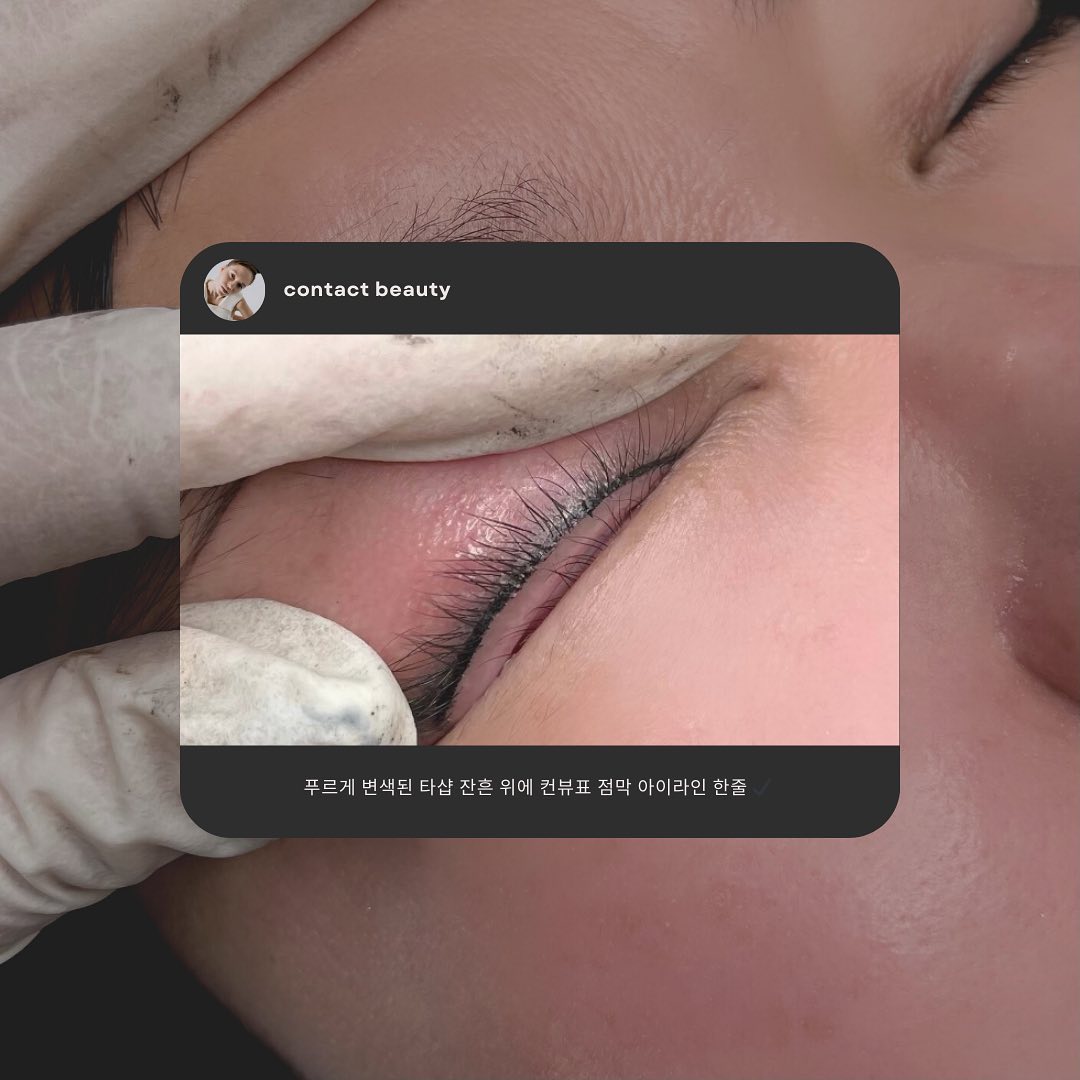 - 𝙚𝙮𝙚𝙡𝙞𝙣𝙚 ⠀
🗒: 점막 아이라인⠀
⠀
오래 전 시술로 인한 푸른 잔흔이 있으신 상태,⠀
퍼진 범위 전체를 커버하면 눈을 뜨셨을 때⠀
쌍커풀 라인이 좁아 자칫 무쌍처럼 보이실 수 있어⠀
얇은 한줄로 선명함 더하며 작업완료👌🏻 ⠀
⠀
⠀
♡̴ 아이라인 이런 분들께 추천드려요 ♡̴⠀⠀
⠀⠀
⋆ 화장 할 때마다 빈 점막 신경쓰이시는 분⠀
⋆ 속눈썹 숱이 부족해 눈매가 흐릿하신 분⠀⠀
⋆ 민낯에도 또렷한 눈 원하시는 분⠀
⋆ 운동,수영이 취미이거나 직업이신 분⠀
⋆ 티안나게 예쁜 쌩얼 가지실 분⠀
⋆ 지난 시술을 확장하지 않아도 또렷하게 하고싶은 분⠀
⠀⠀
˗ˋˏ✄⁃⁃⁃⁃⁃⁃⁃⁃⁃⁃⁃⁃⁃⁃⁃⁃⁃⁃⁃⁃⁃⁃⠀⠀
📲 예약 / 상담 문의⠀⠀
⋆ 프로필 하단 링크 클릭⠀⠀
⋆ 카톡 오픈검색창에 ‘컨택트뷰티’ 검색⠀⠀
⋆ 문자 010.2043.8325⠀⠀
⋆ 당근마켓 ‘컨택트뷰티’ 친구추가 후 채팅⠀

⠀

⠀

⠀

⠀
#울산동구아이라인 #울산동구점막아이라인 #울산동구언더아이라인 #울산동구반영구 #울산동구컨택트뷰티 #울산동구입술문신 #울산동구눈썹문신 #울산동구남자눈썹 #울산동구여자눈썹 #울산동구잔흔커버업 #울산동구속눈썹 #울산동구에스테틱 #울산동구중년눈썹 #울산동구학생눈썹