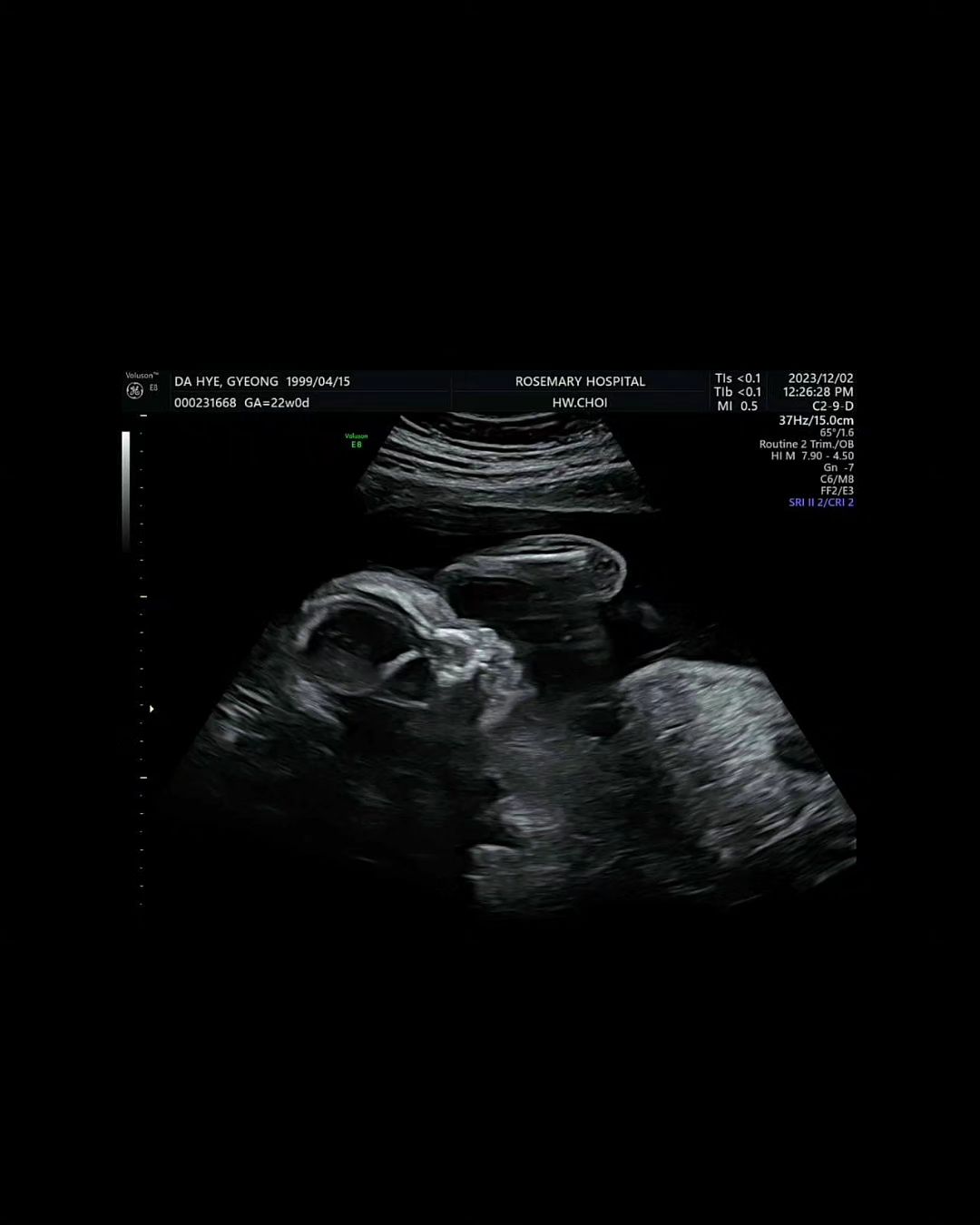 알밤아 방가웡🌰
계획하자마자 생긴 둘찌...🤣
채이누나 4월에 만나유🤎

#늦은임밍아웃👶🏻 #22w3d #둘찌가찾아왔어욤