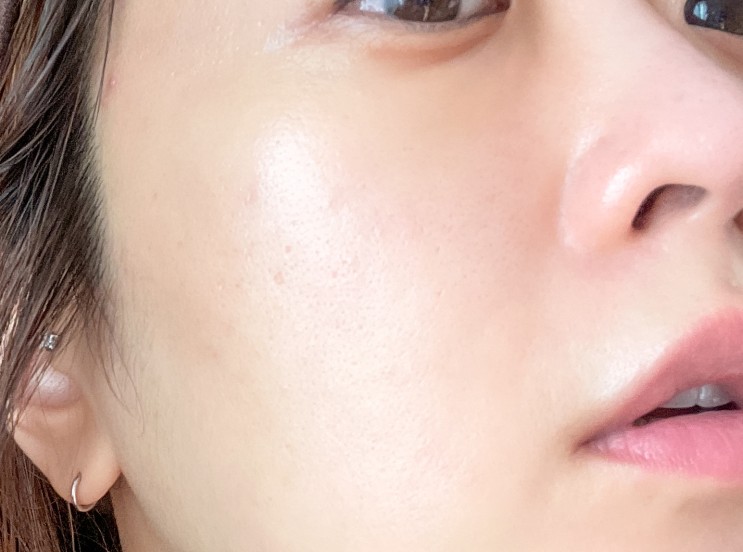 피부 건조 너무 심해서 받아본 압구정역 리제반 후기