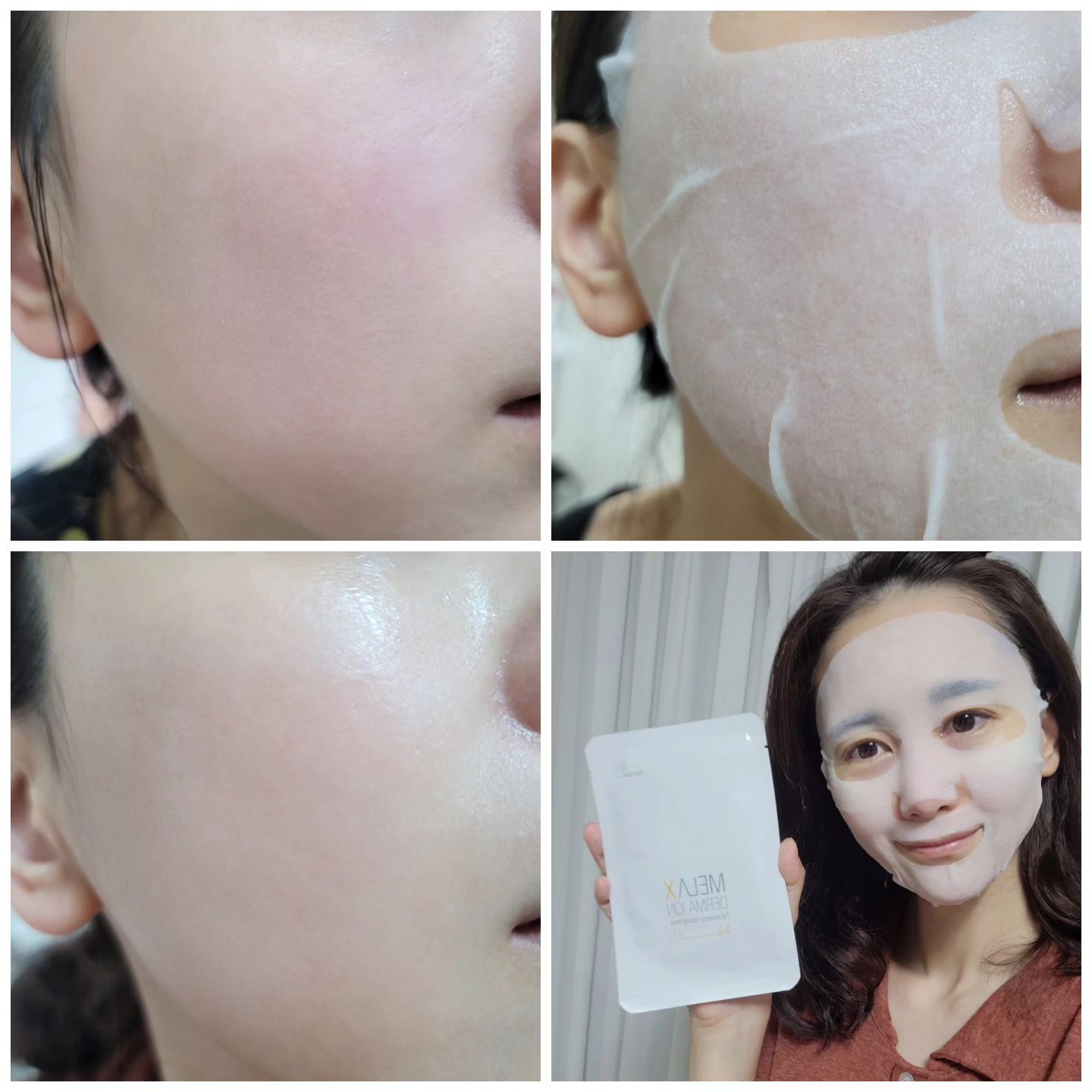 열감피부 진정시키는데 
최고였던 #마스크팩추천 ✨️
원래 피부사진 이렇게까지 안올리는데ㅋ
변화가 너무 좋아서 비포애프터 샷 많이 추가함!
진짜 찐 좋았던 #수분팩👍👍

요즘 피부 열오르고 😡
푸석 #건조한피부 🙀상태인데
#멜라엑스 #더마이온 #릴렉싱마스크 하고 나면
탱탱하고 촉촉함 대박임
탱탱하게 보습감 채워짐
진짜진짜대박임!!!! 🥹🩷
제일 놀랐던건 15분만에 #홍조 #열감 진정되던거!!
알로에도 있고 특허받은 자연성분이 많았구나!
어쩐지 #민감성피부 인데 잘받드라!🙇‍♀️

이렇게 길게 쓸 생각없었는데 
현실로 좋아서 말많아짐  완전 추천!
예민한 #건성피부 라면 무조건!!!!

#아름다운나라화장품 뭐야 👩‍🔬
제품 잘 뽑네! 내 피부에 딱맞어ㅜㅜ
기초도 사볼까나
쇼핑몰 구경하는데 깔끔하고 제품도 한눈에 들어오고
리뉴얼된 홈페이지 #좋아요 굿

https://www.anaclimall.com/MASK/?idx=197
마스크팩 또 구매하면서 
#아나화장품 으로 정착간다

#협찬 #마스크팩 #수분마스크팩 #얼굴팩 #히알루론산마스크팩 #피부보습 #팩 #피부진정팩 #진정팩 #진정마스크팩 #수분진정팩 #팩추천 #고농축보습에센스 #고보습마스크팩 #아름다운나라피부과 #아름다운나라화장품 #beauty #뷰스타그램