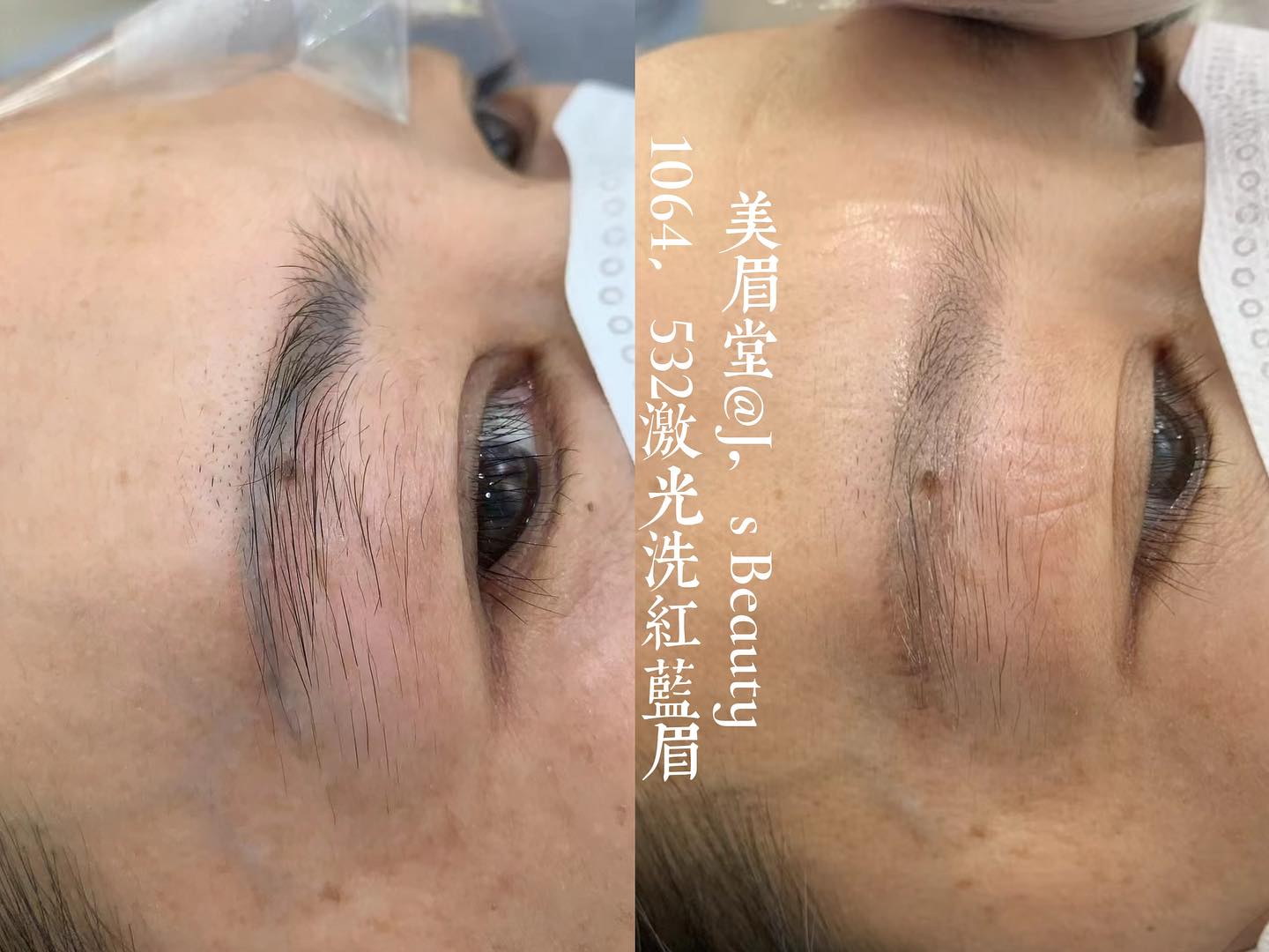 激光洗紅、藍眉
無損毛髮
#1064
#532
#美眉堂