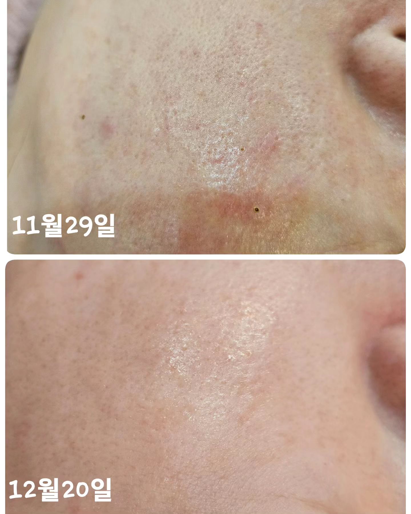 플라즈마 모공관리
3주만에 정말 가능합니다 

나비존 모공축소 완전 찐템이죠 
저는 톤업과 기미에 효과 완전 봤는데 
모공은 덤이 였거든요 

근데 고객님은 오로지 모공!
무조건 모공이였어요 

더 오래걸릴줄 알았는데 정말 
이럴순 없어요 3주만에 모공이 
싸악 !!!모공축소 완전 최고 

플라즈마는 다양한 피부에 
팔방미인으로 효과르 볼수 있는데요 

-이미 진행중인 여드름 
-여드름 자국 
-기미 색소 
-홍조 붉음증 
-예민 민감
다양한 피부에 확실한 효과를 
볼수 있답니다 

모공축소 됐으면 말다했쥬 
예민한 피부 민감한 피부도 
자극없이 편하게 받을수 있는 
플라즈마 !

12월 플라즈마 홈케어 이벤트 
꼬옥 혜택 받으세요 !

#송탄 #플라즈마 #모공축소 #톤업