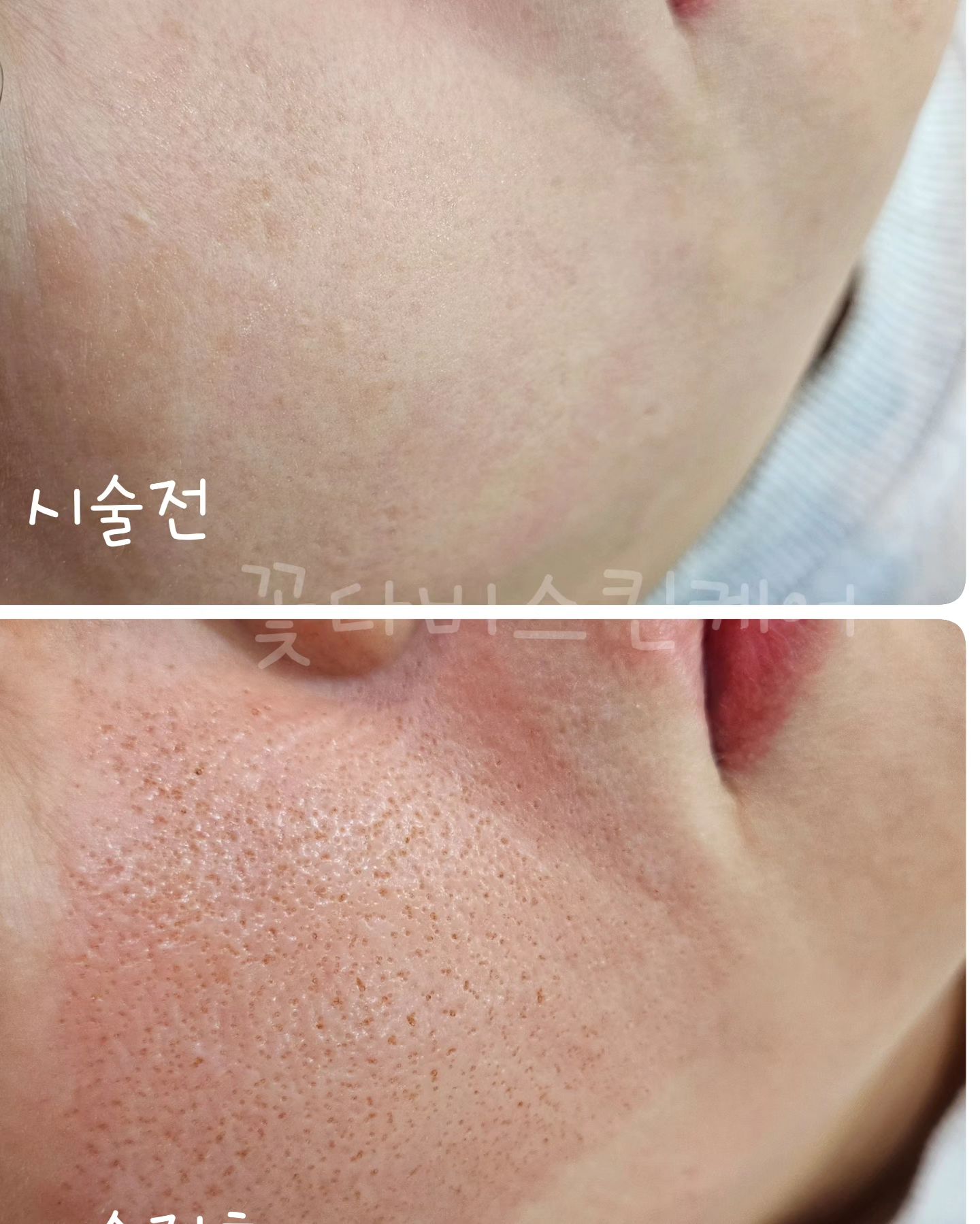 플라즈마×스킨타이트닝 
양볼 모공 ×팔자주름 한번에 케어하기 
2회차 스킨타이트닝 관리중 첫번째에도 효과 넘좋았지만 
사람의 욕심은 끝이 없는법! 

모공이 즐어드니 더더더 욕심 나서 이제 안보였으면 
좋겠습니다 #모공축소 #코피지 제거까지 득템💆‍♀️

리프팅이 되면서 모공이 줄어들고 피부재생이 되면서 
피부결도 매끈해지고 잡티도 사라져요 

이제 이뻐질일만 남았네요 

#필러 #보톡스 효과 부작용없는 플라즈마 × 스킨타이트닝 
레이어드 하듯 한달에 한번씩 하고 이제 유지만 합시다 

개인의 재생력에 따라 노화의 정도에 따라 다 다르게 
관리하고 효과도 다 달라요 

그래도 빵빵하게 차오르고 매끈해 지는건 똑같아요
어떻게 관리받고 .관리하느냐에 따라 달라집니다 #얼굴 

 나에게 맞게 디자인 하고 내피부에 맞게 관리합시다 

#송탄 #플라즈마 #메디컬스킨케어 #신장쇼핑몰