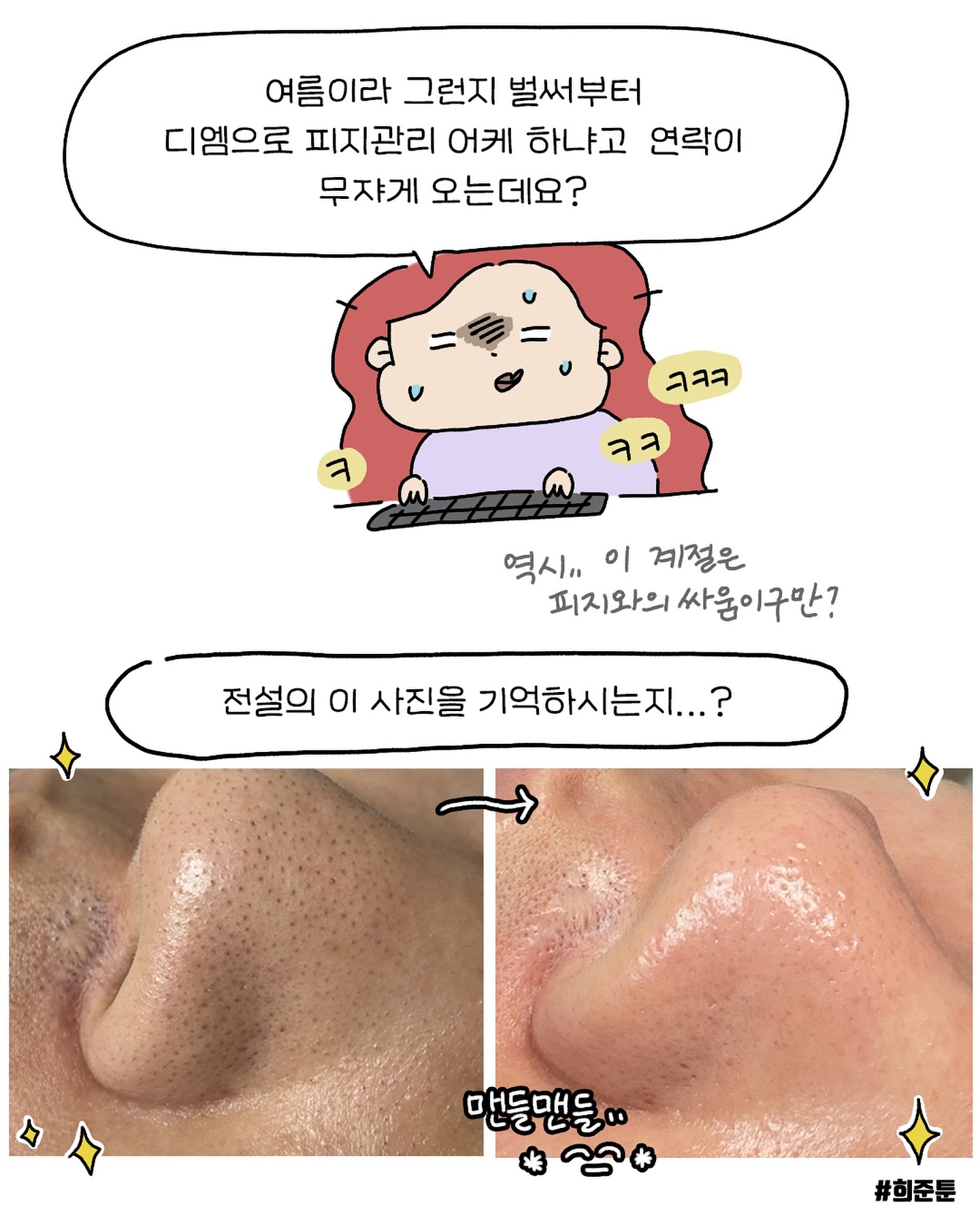 여러분 더운 날씨 피지관리하기 힘드시져!?!??
마침 파격적인 프로모션이 나왔어욧,,,! (진짜 간만에 왔다^^,,,)
피지 쏘옥 뽑기 + 모공 클린하게 닦아주는 세멘시트랑
모공을 빈틈없이 빵빵하게 채워주는 ! (제가 넘모 ㅅㅏ랑함,,, 모공뿐만 아니라 요새 나이들어보인다? 꼭 쓰셔야 해요 *^^*)
빵빵이크림 무려 40회 분량을 쓸수있는 프로모션이 열렸는데
무려 22만원의 혜택이에유💖
홍보도 거의 안한 것 같은데 정말 많은분들이 뽀려가시더라구용,,, ^^,,, 역시 우리 보는눈은 다 똑같져?

오랜만에 혜택 좋은 프모! 7월14일 일요일밤 12시까지니까
피지창궐 대비해서 낭낭하게 준비해 보아요 ✨️

.
.
.
.
.
.
.

#희준툰 #피부관리법 #희준툰피부관리 #에스테틱화장품 
#파메스테틱 #피지 #모공관리 #여름 #피부툰