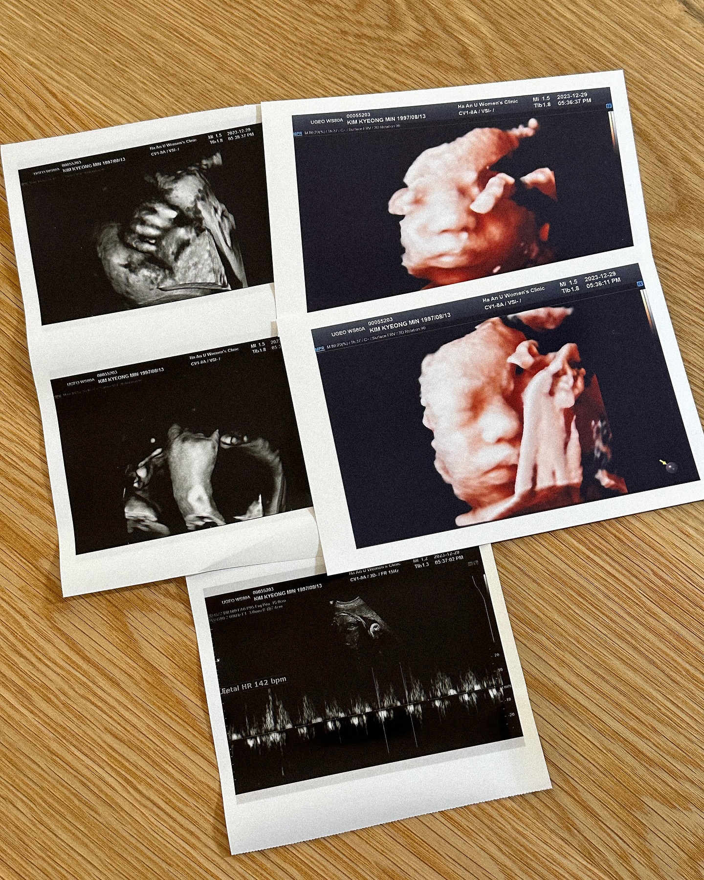 길까꿍 1.9kg :)
원장님이 아기가 작은편이 아니라며, 출산 시 3.5kg 정도 예상하신다며 ... 우리 까꿍이 아주 쑥쑥- 잘 크고 있구나 🤍
오늘은 브이- 하고 있는 모습 포착 ! 원장님이 "아기 브이하고있네 !" 하시는데 심장 뿌시는줄 ... 너무 귀여워 우리 딸 👶🏻🎀
엄마, 아빠는 우리 까꿍이 41일뒤 만날 생각에 너무 설레 🫧🤍
2주뒤에 또 만나자 우리 딸 사랑해 !!!!
#32w2d / D-41