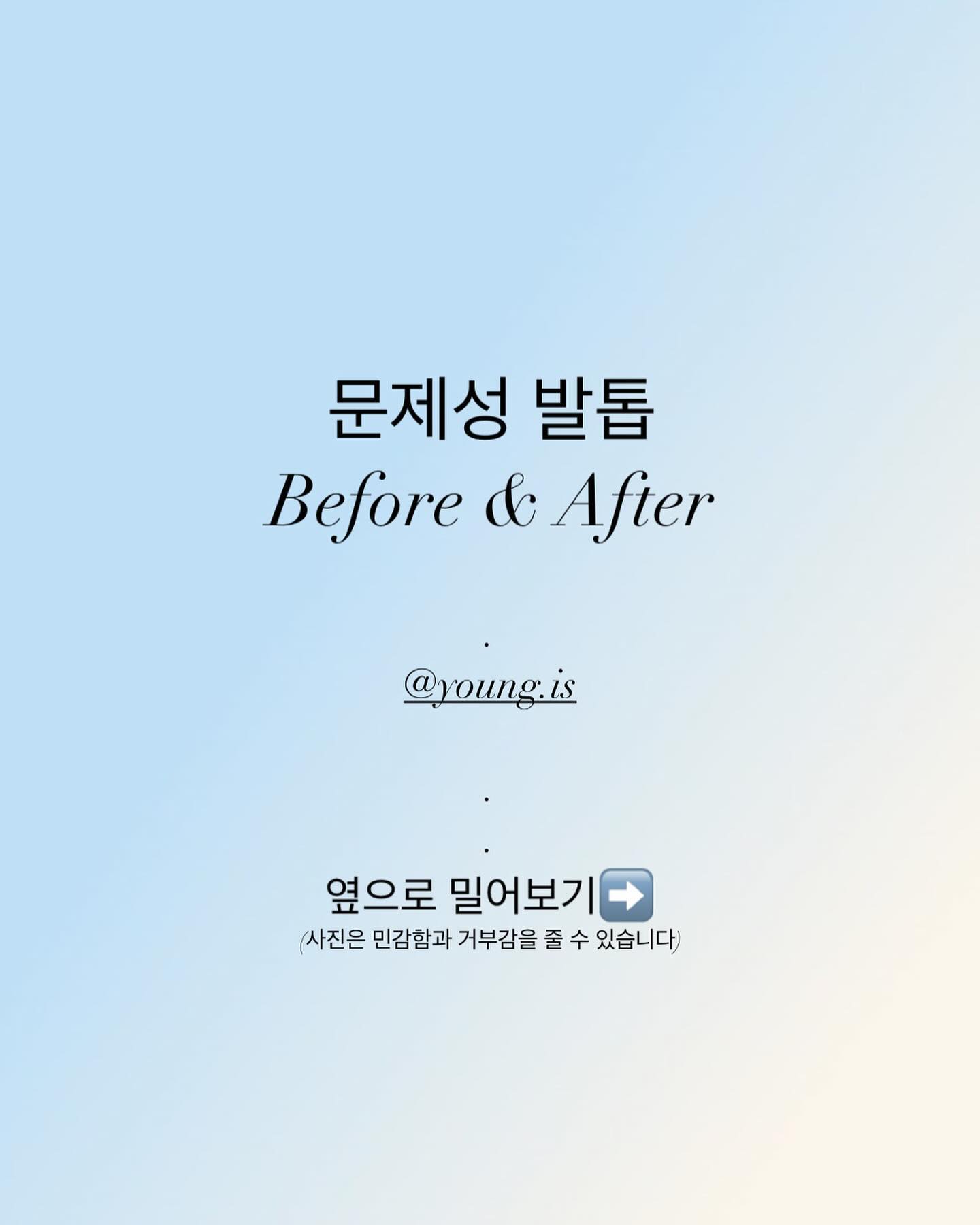 위 고객님은 
몇년전에 내성발톱 시술을 받으셨던 고객님이세요😊
교정을 한 후 관리를 계속 하지않으셔서 다시 재발해서 
+염증까지 생기는 바람에 걸음이 너무 불편하셔서 
저희샵을 오시게 되었어요😭
첫 시술하고 4주 뒤에 시술 된거 보시면 
염증도 많이 완화되고, 발톱도 많이 펴지셨답니다👍🏻
”테이핑해주시면 더 좋아요~“ 저의 한 마디에 
테이핑도 꾸준히 해주셨다는 고객님🤍
남은 시술들도 화이팅이에요✊🏻
.
문제성 발관리는 
고객님과의 충분한 상담 후, 시술 들어갑니다💙
.
➰01028766350 / 프로필 오픈채팅 문의
➰부산 북구 와석장터로 6-11 영네일 
.
.
.
#문제성발톱 
#부산문제성발톱 
#문제성발
#부산문제성발
#발톱교정
#화명동발톱
#화명동문제성발톱
#내성발톱
#무좀발톱
#화명동내성발톱
#화명동무좀발톱
#부산내성발톱
#부산무좀발톱
#화명동네일
#화명동네일샵
#화명네일
#화명네일샵
#화명동
#화명동맛집
#화명맛집 
#화명동문제성발관리전문샵 
#부산문제성발관리
#부산발관리
#부산발톱관리 
#화명동발관리
#화명동발톱관리