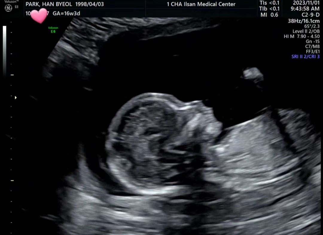 #17w1d 짱짱이기록🩷
1,2차 기형아검사 모두 정상!