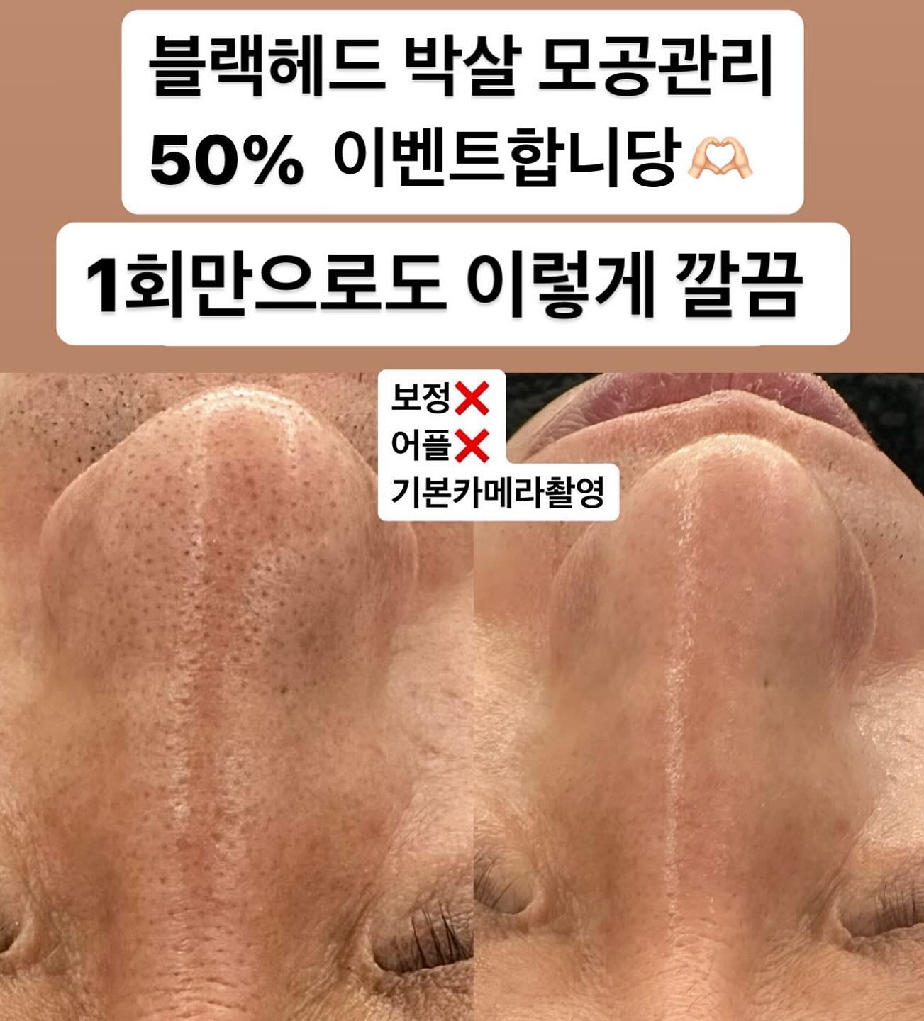 블랙헤드 박살 초특가이벤트 🫶🏻
2월한정 50%할인해드립니다
거뭇거뭇블렉해드 싹 없애드립니다! 
붉어지고 따갑고 자극적인 필 시술이 아니에요!
부작용❌ 통증❌ 
보들보들 아기피부 🙆🏻‍♀️