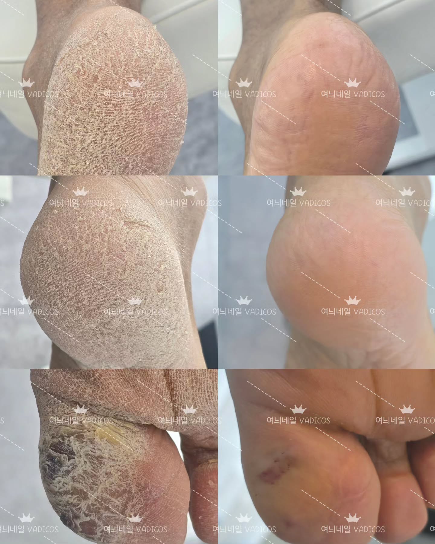 이불을 아내분께서 하루에 몇번씩털어내고 청소기를 늘 들고다니신답니다ㅠㅠ
발각질 방치가 답이 아니에요ㅠㅠ
갈라지고 아프고 양말을신고 보습을한다고해도 좋아지지않아요~~

숨기지말고 관리하세요^^♡
여늬네일이 함께 도와드릴께요♡

항상 노력하는 여늬네일이 되겠습니다^^♡

월-금 10시~9시
토요일 10시~7시
네이버예약가능
010-2034-3256 문의주세요^^
시술시 전화나 문자는 답변이 늦어질수있습니다.
불편한 손발톱 이젠 감추지말고 관리받으세요^^
1:1 맞춤시술, 문제성손발톱, 짱짱한 유지력
여늬네일로 네일아트하러 오세요^^

👇👇여늬네일위치
경기도 남양주시 진접읍 봉현로32, 4층 여늬네일
장현 베스킨라빈스 건물 4층
장현 현대병원 도보 3분

#네일하는뇨자 #여늬 #여늬네일 #문제성손발톱 #네일맛집 #진접네일 #진접네일샵 #장현네일샵 #바디코스