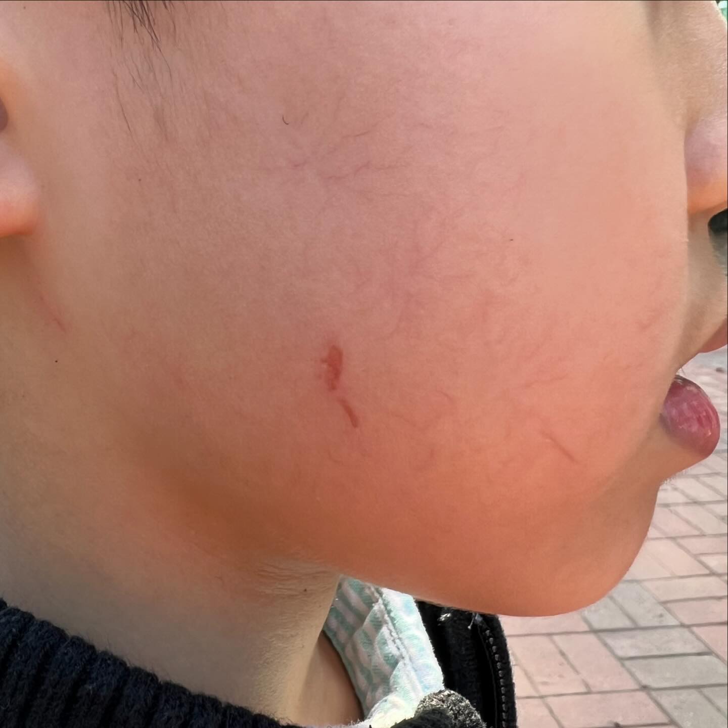 화가나네 ㅜㅜ 
얼굴이 이래된는데 . . . 

어린애를 상대로 화를 낼 수 도 없고. . . 
좀 심한거같아서 말하려해도 #맘충 되는건가?싶고. . . 

속상해죽겠네 ㅜㅜ 

화가 나는 내가 속이 좁은가?
속상한 내가 잘못된걸까? ㅜㅜ 

#이지경 #울고싶다 #아프지말라고 #다치지말라고 #싸우지말라고